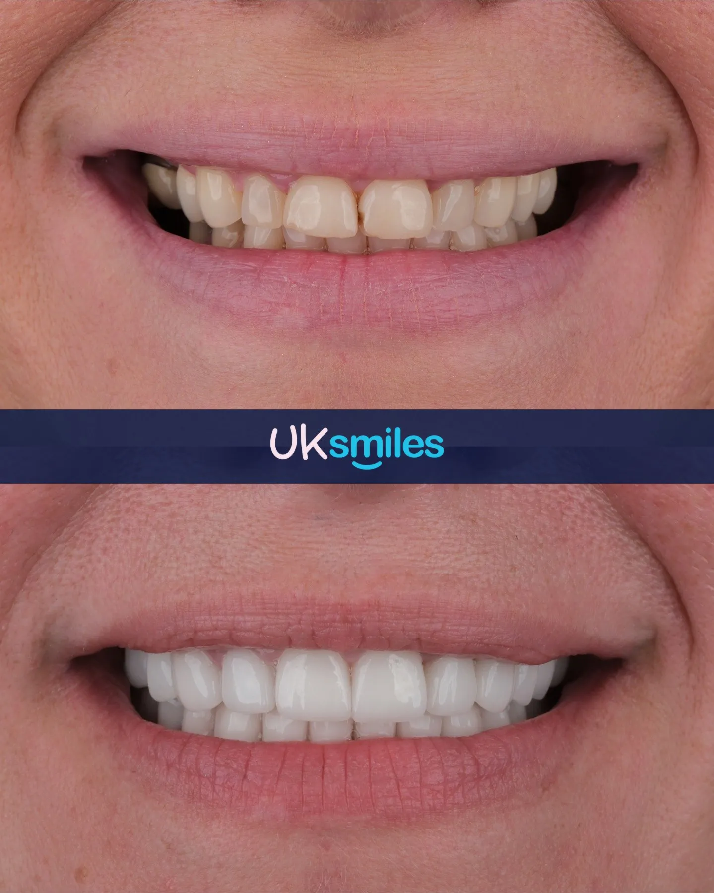 Close-up of discoloured front teeth before and a clean white smile after