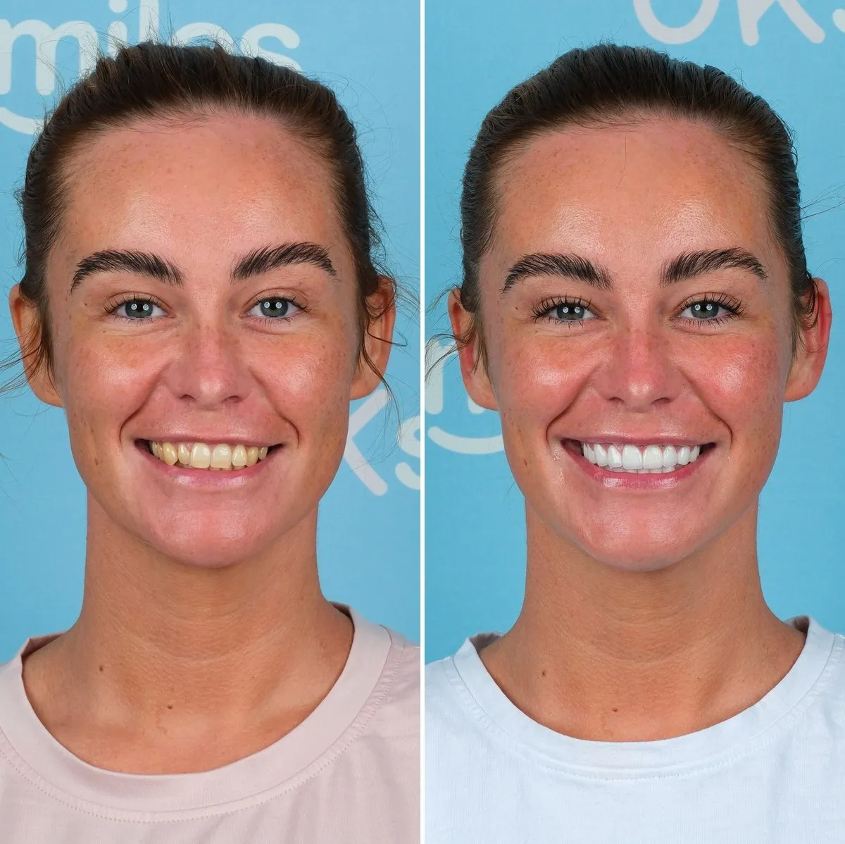 Ellie before and after zirconia crowns with UK Smiles