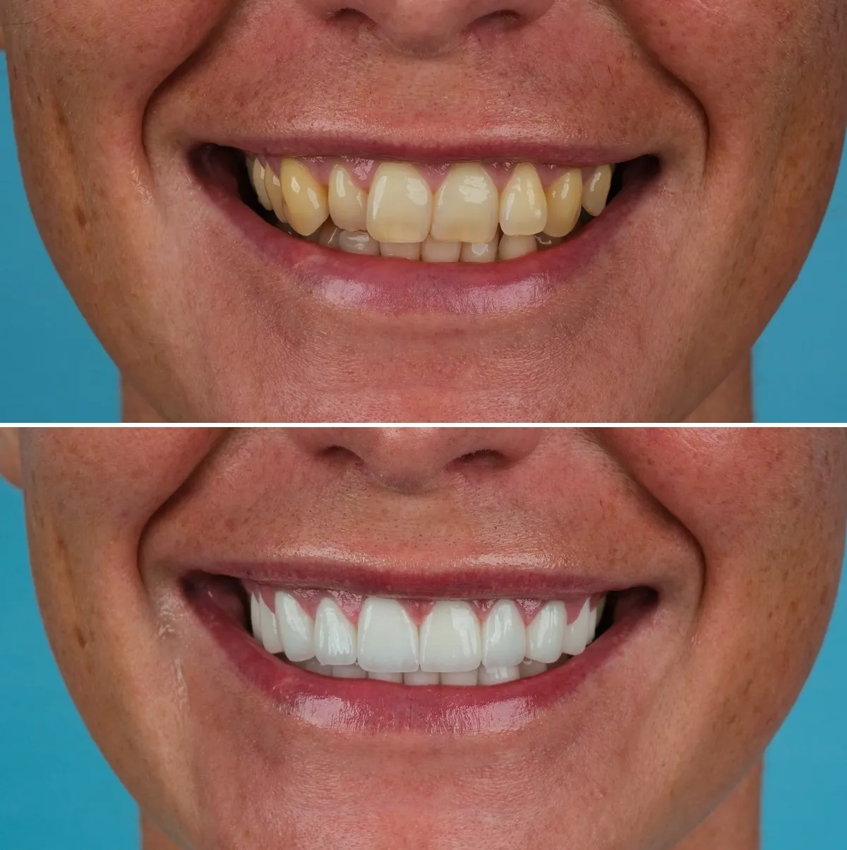 Close-up of Ellie's teeth before and after Zirconia Crowns, view 1