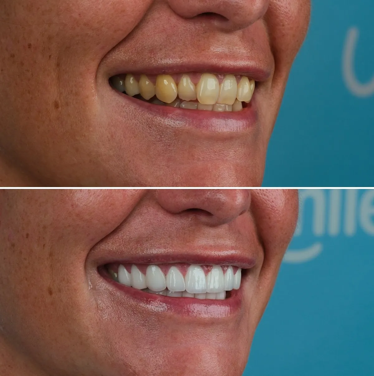 Close-up of Ellie's teeth before and after Zirconia Crowns, view 2