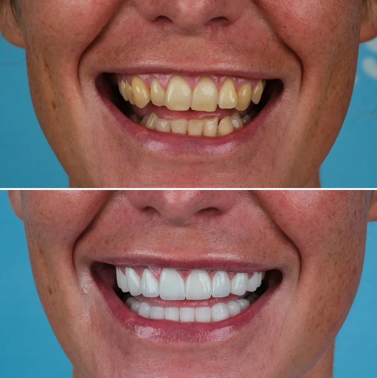 Close-up of Ellie's teeth before and after Zirconia Crowns, view 3