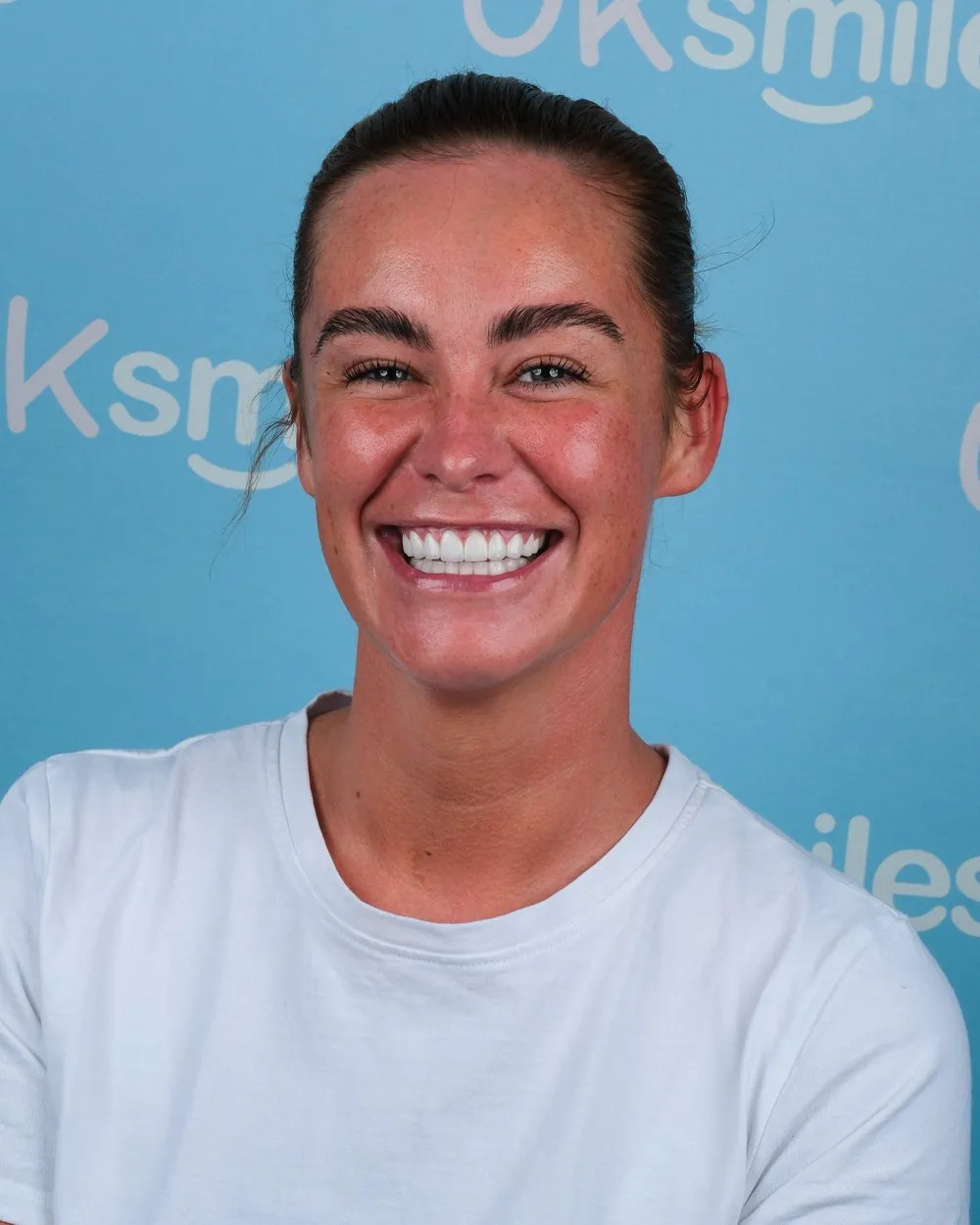 Ellie after Zirconia Crowns with UK Smiles in Antalya