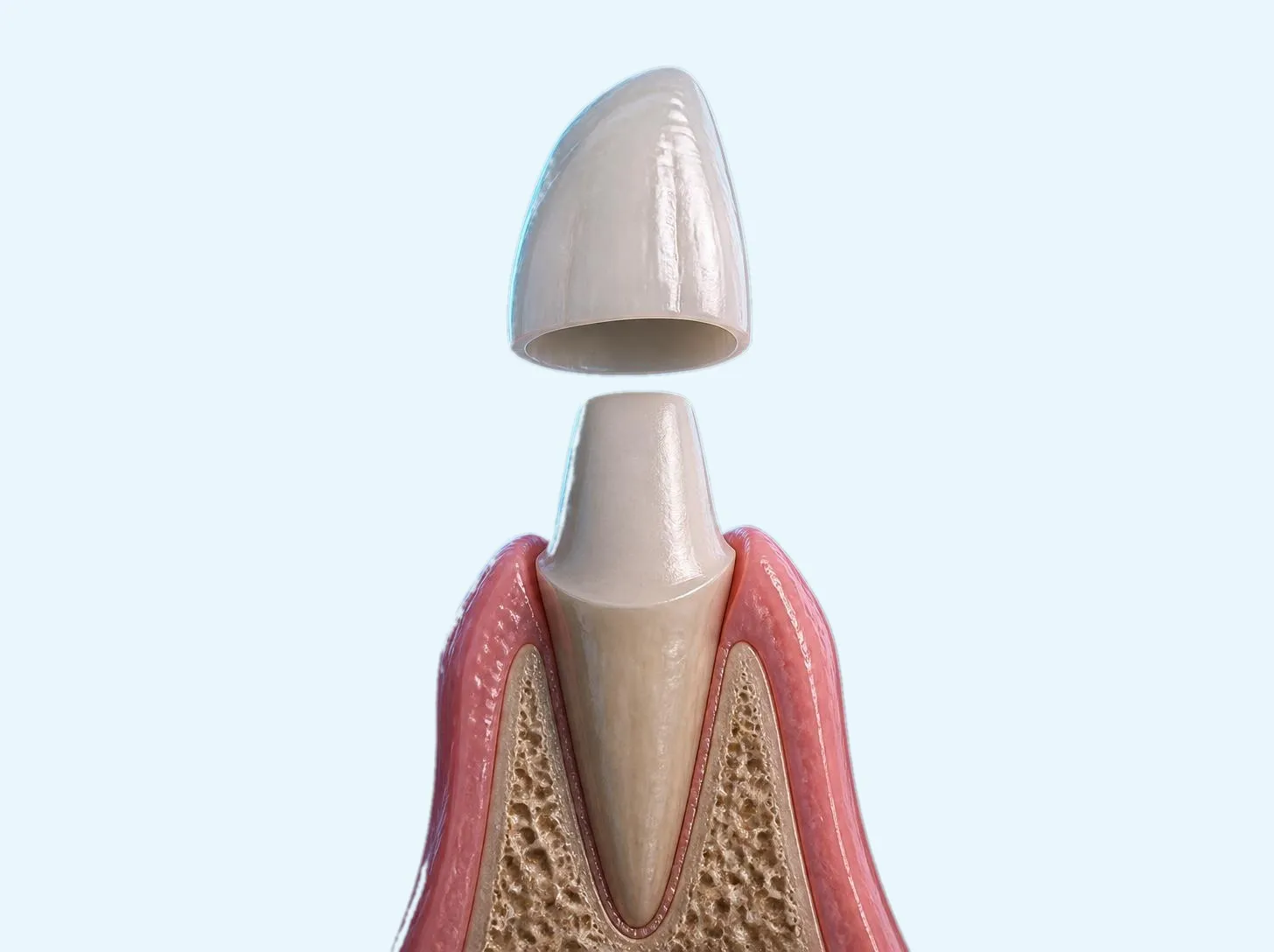3D illustration of a translucent Emax lithium disilicate crown fitting over a prepared front tooth