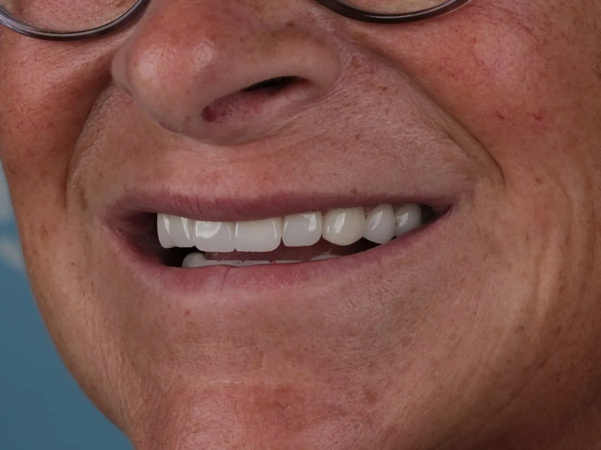 Close-up of a UK Smiles patient smiling with her new Emax crowns