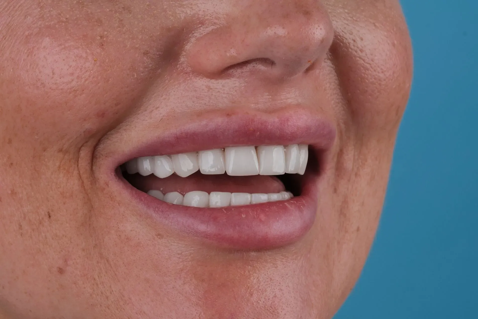 Smile close-up against a blue background showing bright white Emax crowns