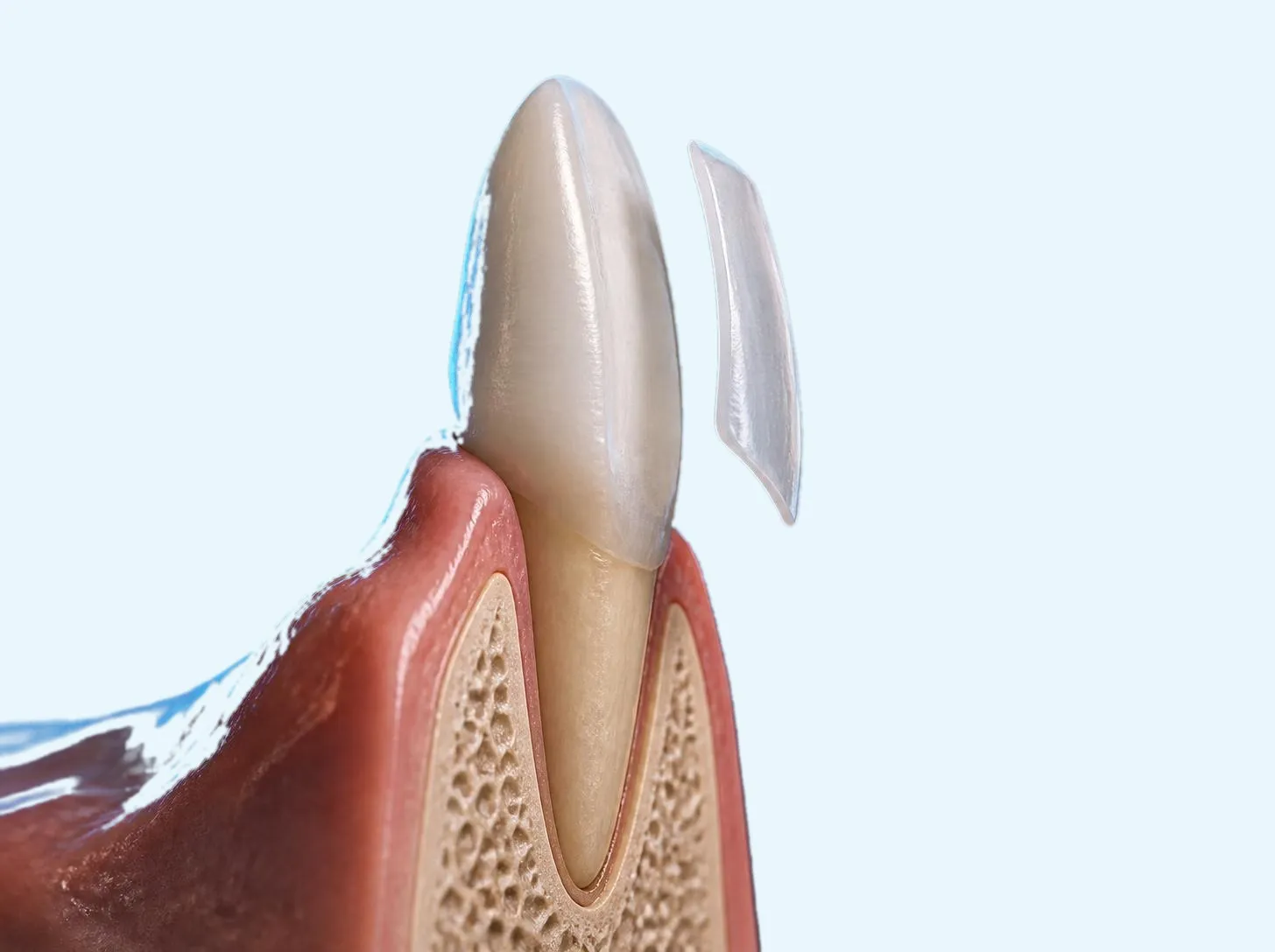 3D illustration of an Emax veneer bonded to the front of a tooth
