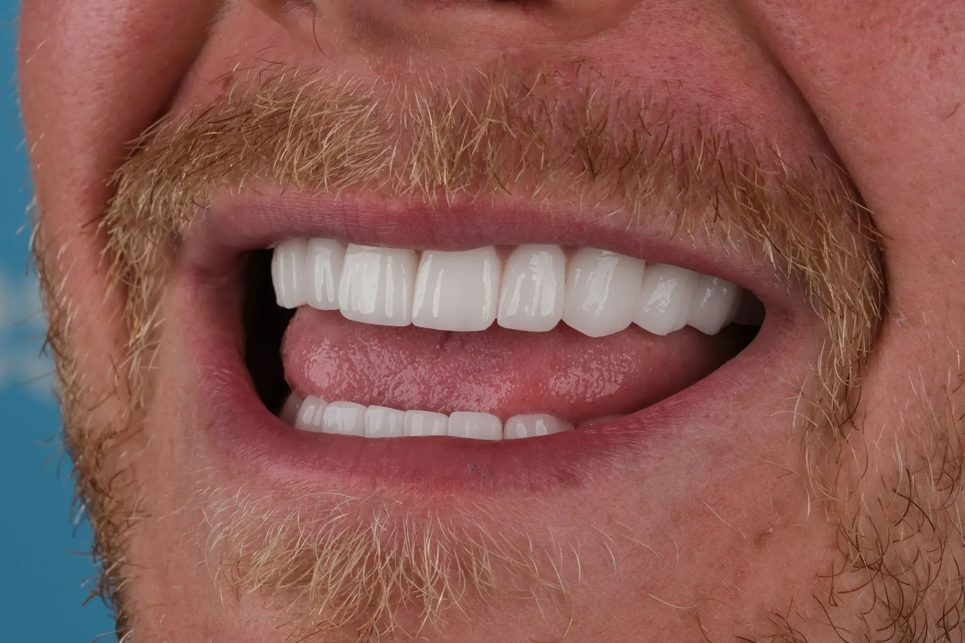 Close-up of a smiling man with a light beard, showing perfect white teeth after Emax veneers