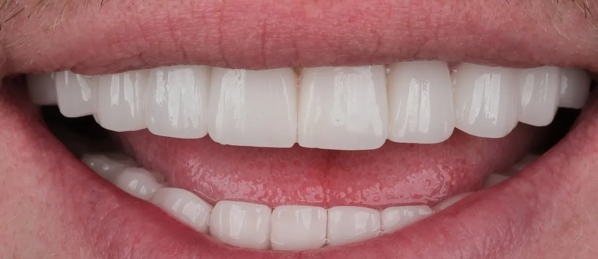 A UK Smiles patient's smile after treatment: BL1 shade, Hollywood style