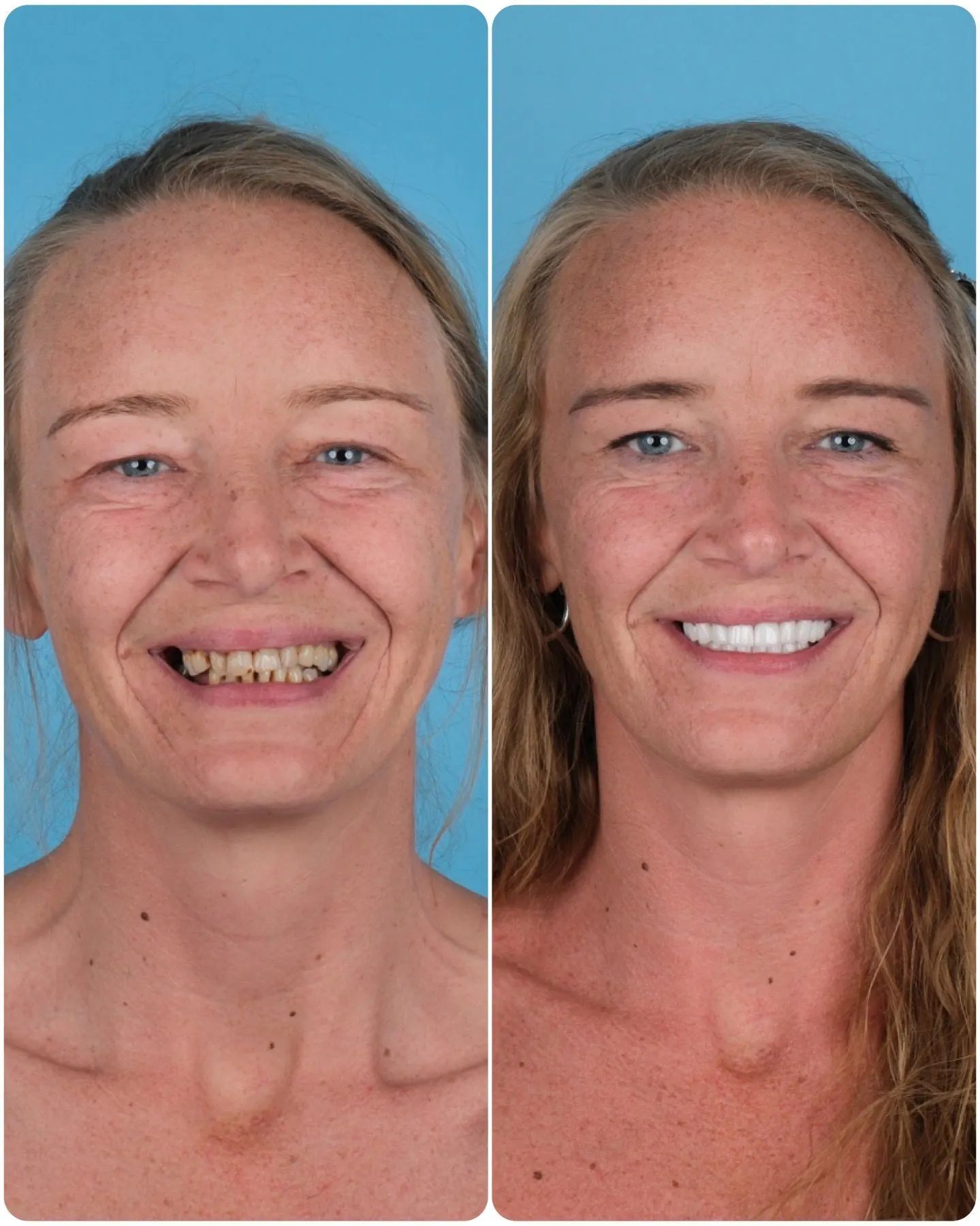Woman with fair hair and discoloured teeth before and a white smile after