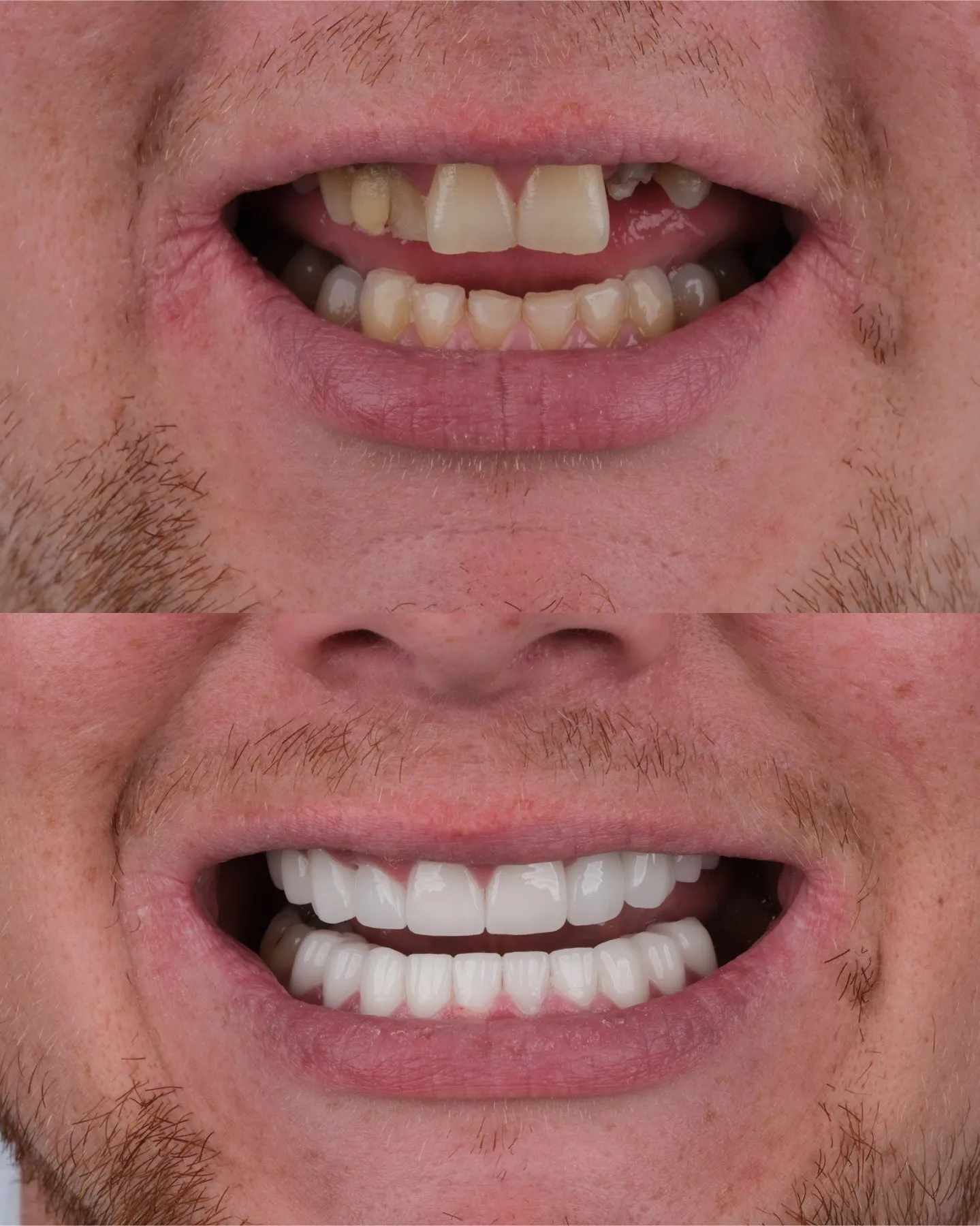 Close-up of a smile with a missing tooth and worn teeth before, and a full white smile after