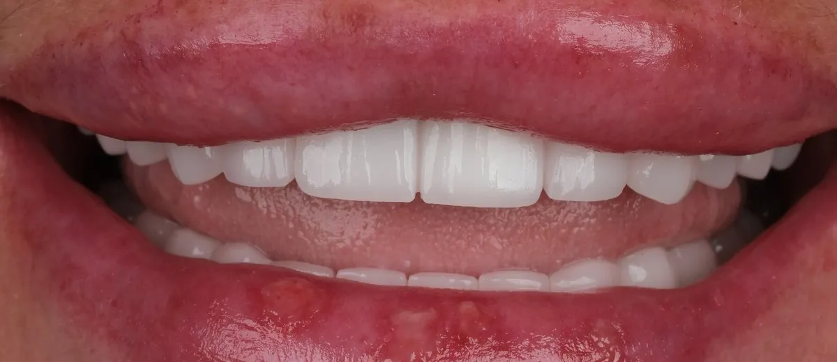 A UK Smiles patient's smile after treatment: BL1 shade, Natural style
