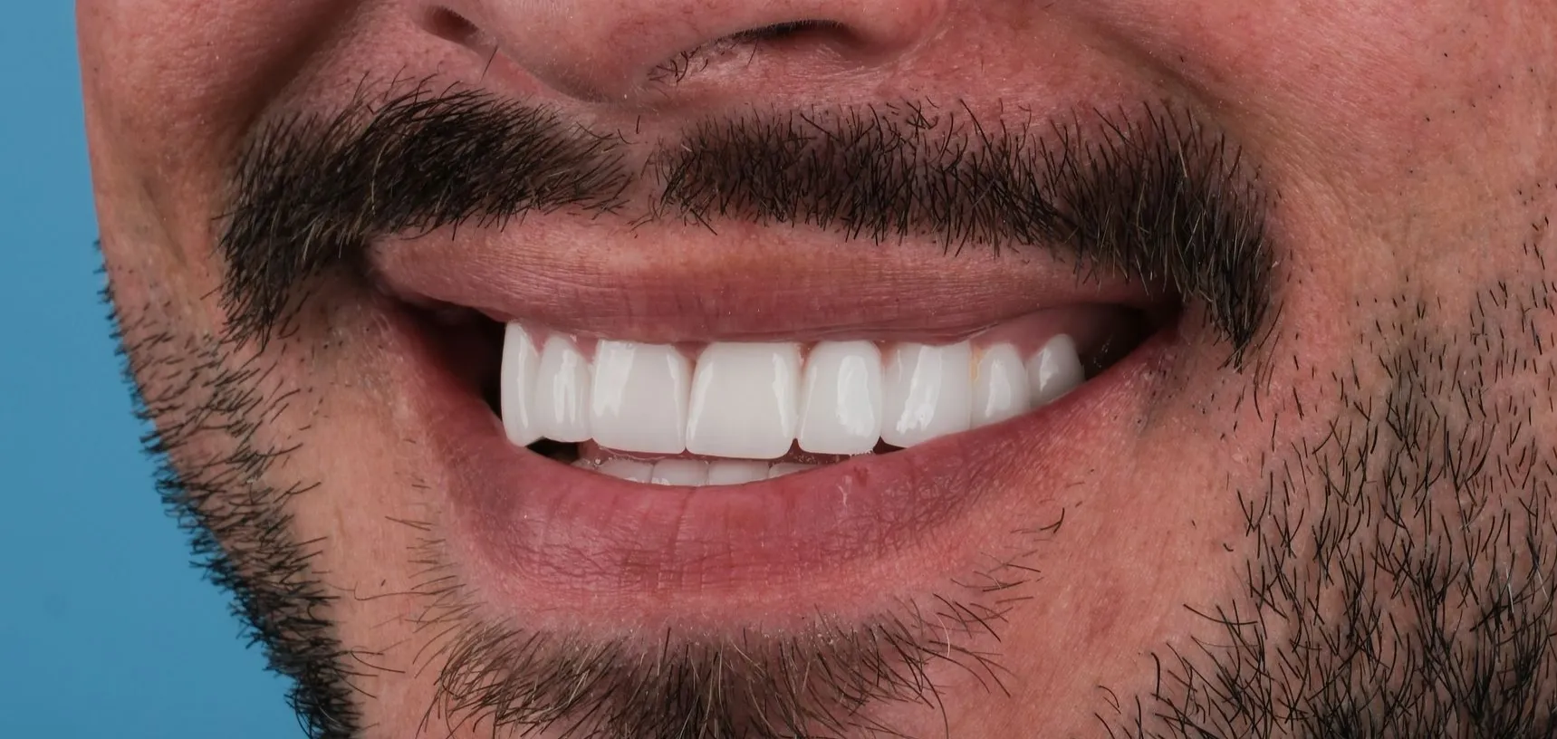 digital smile design planning for a Hollywood smile in Turkey