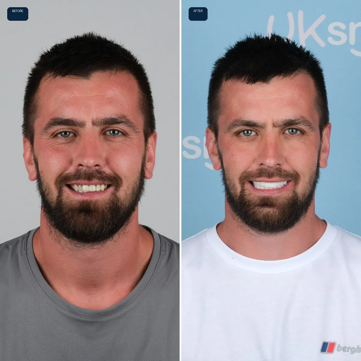 Jack's face before and after Dental Implants and Zirconia Crowns at UK Smiles in Antalya