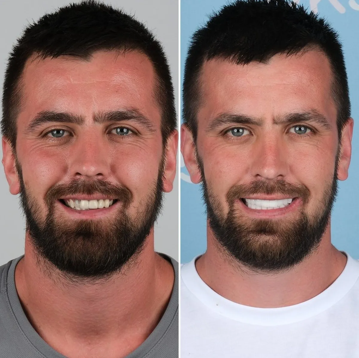 Jack before and after implants and crowns with UK Smiles