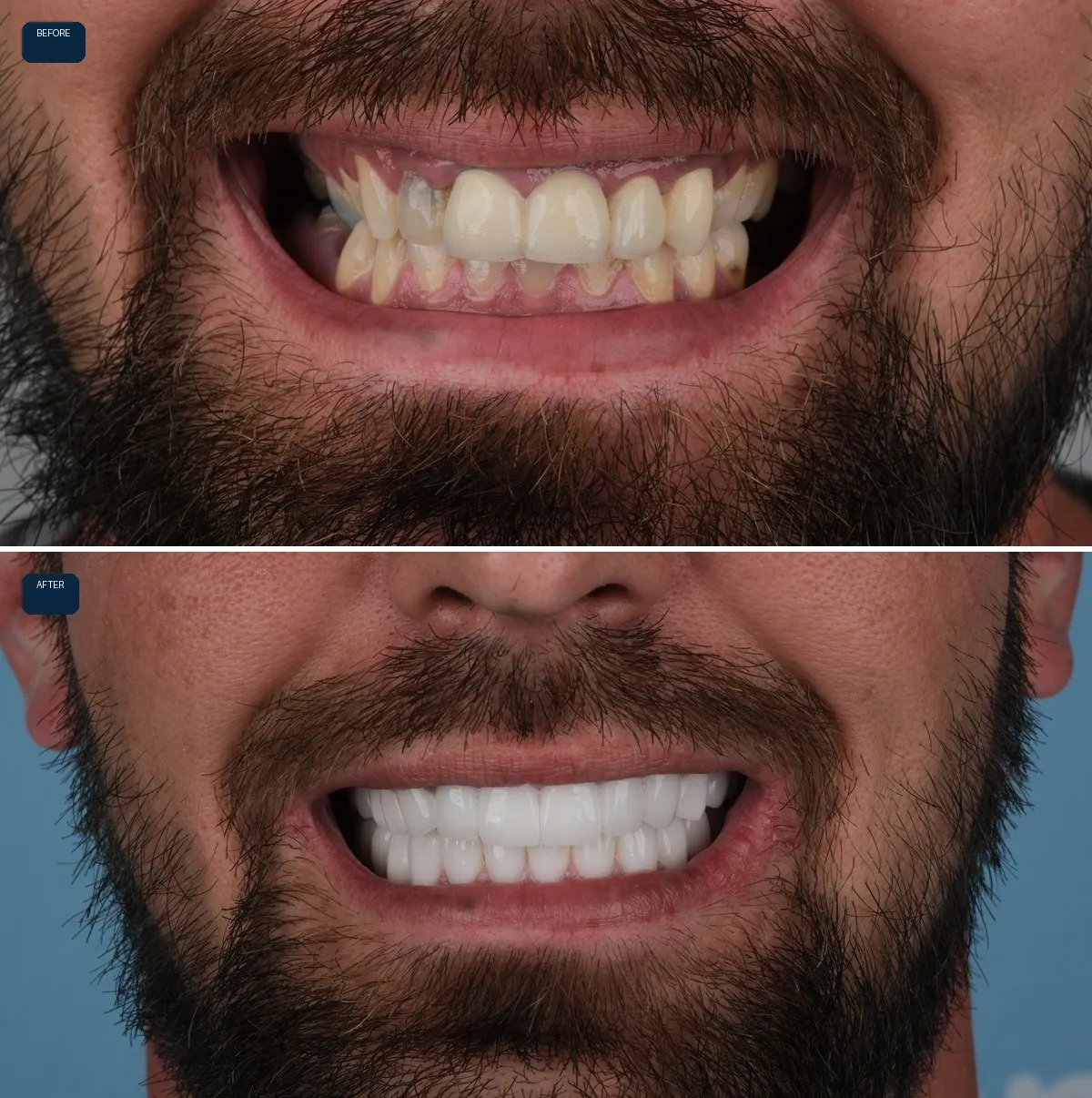 Close-up of Jack's teeth before and after Dental Implants and Zirconia Crowns, view 1