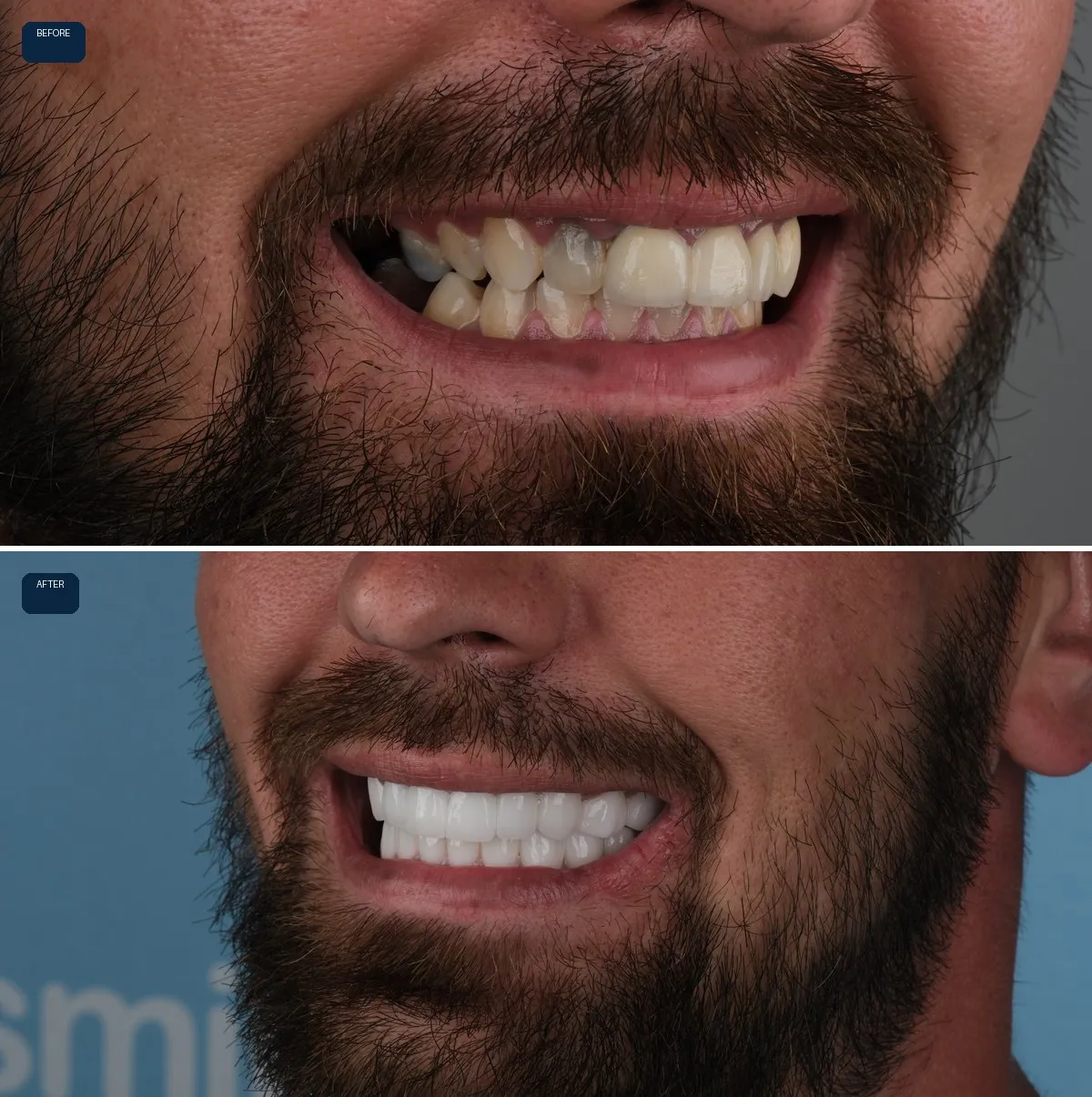 Close-up of Jack's teeth before and after Dental Implants and Zirconia Crowns, view 2