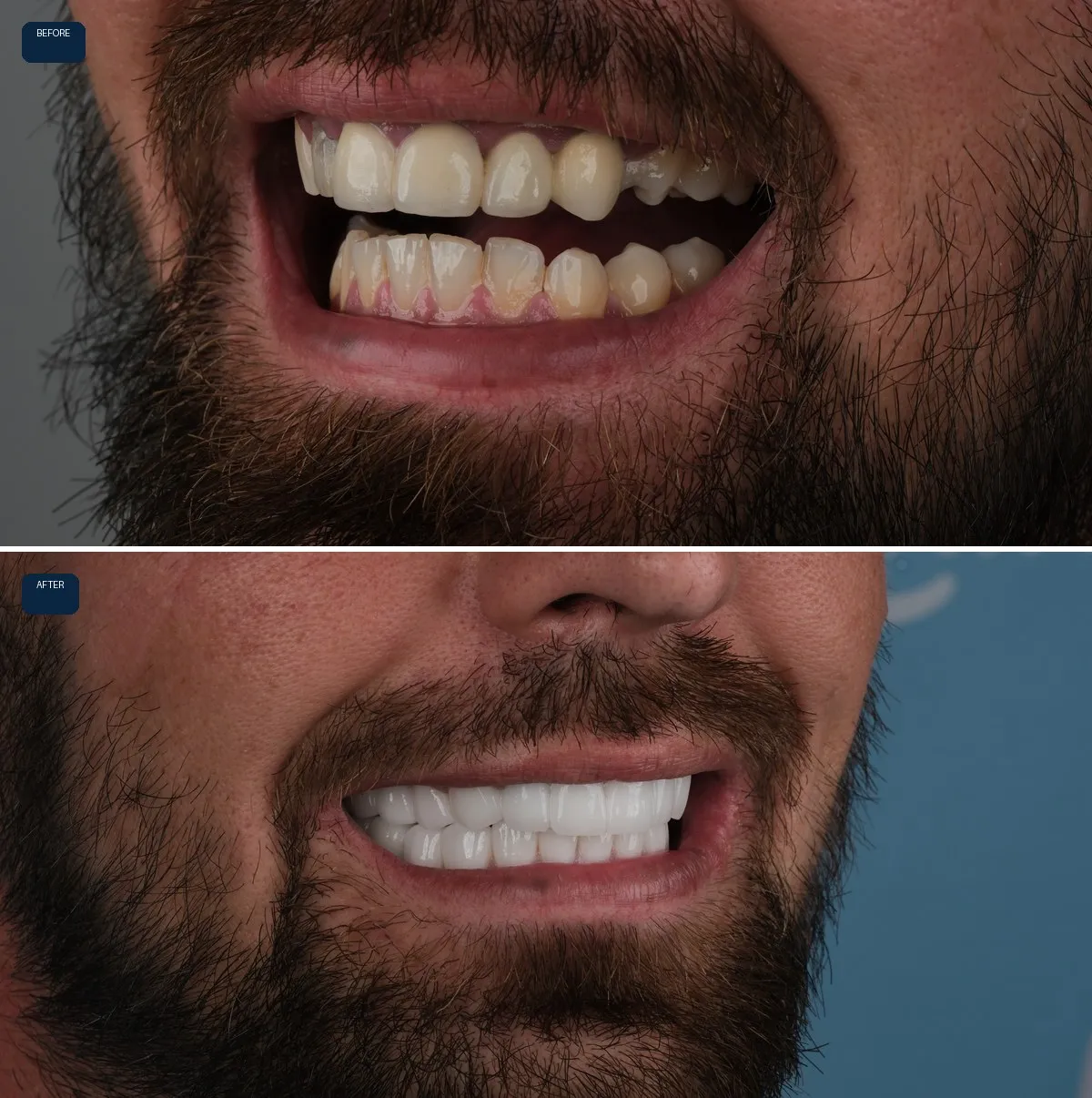 Close-up of Jack's teeth before and after Dental Implants and Zirconia Crowns, view 3