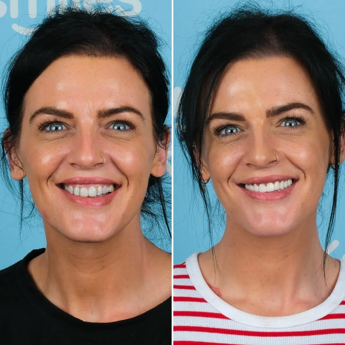 Jodie before and after zirconia crowns with UK Smiles