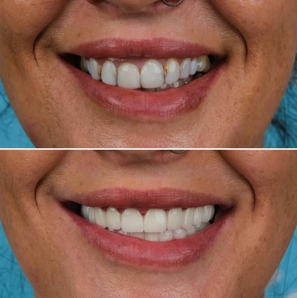 Close-up of Jodie's teeth before and after Zirconia Crowns, view 1