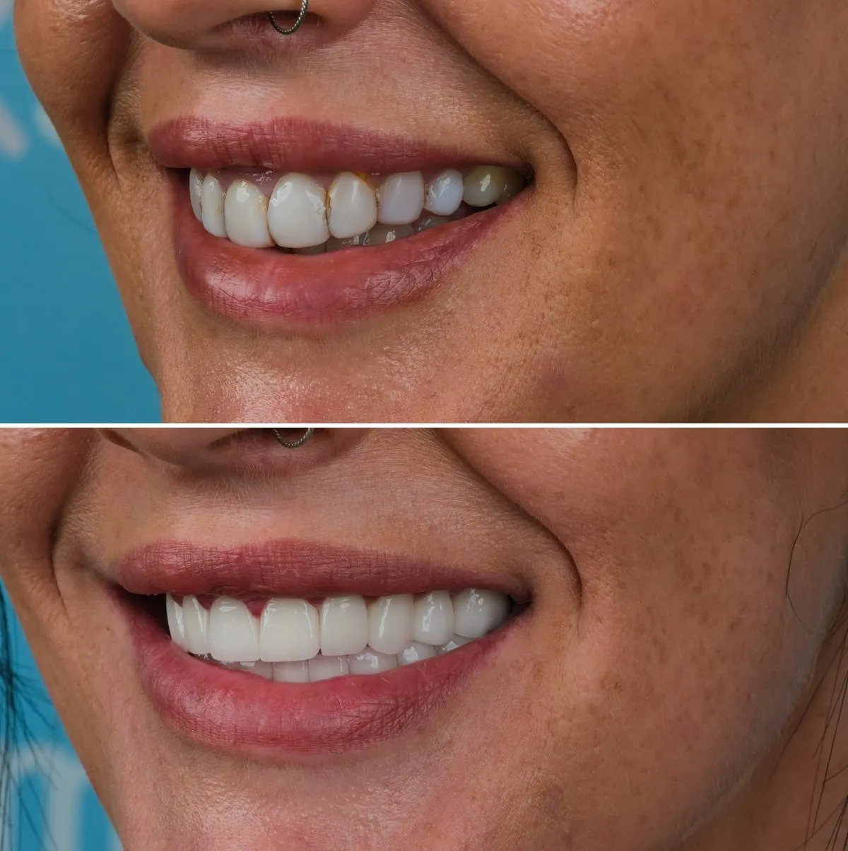 Close-up of Jodie's teeth before and after Zirconia Crowns, view 2
