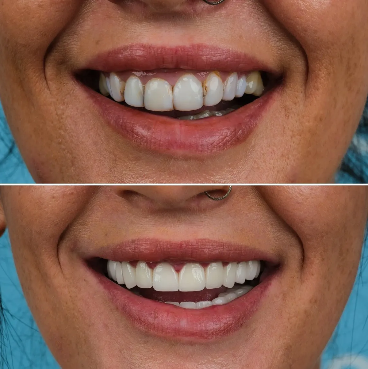 Close-up of Jodie's teeth before and after Zirconia Crowns, view 3