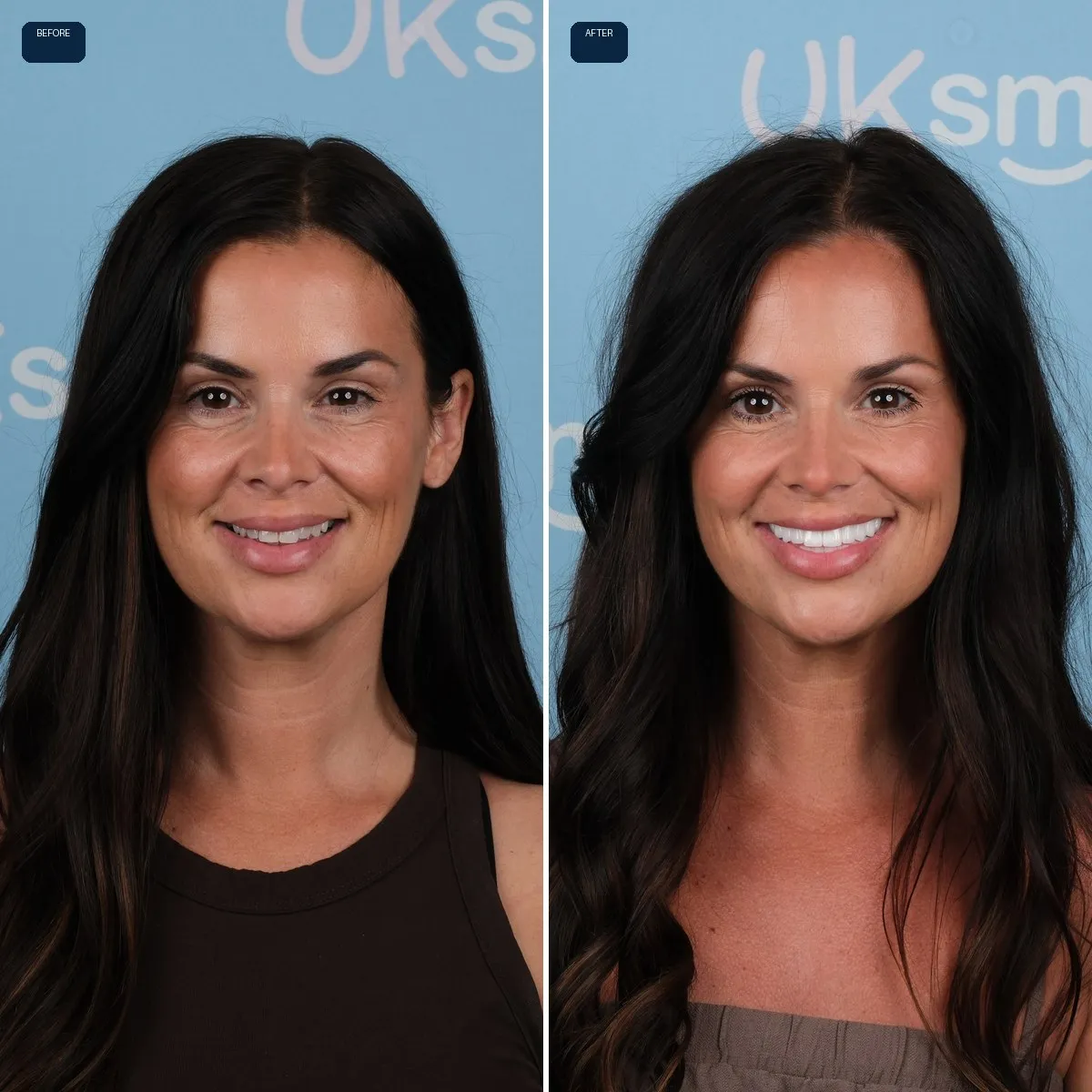 Jody's face before and after Zirconium Crowns at UK Smiles in Antalya