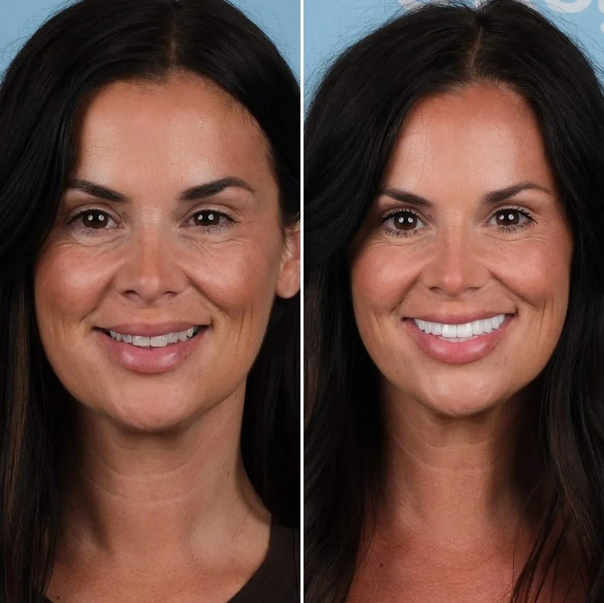Jody before and after zirconium crowns with UK Smiles