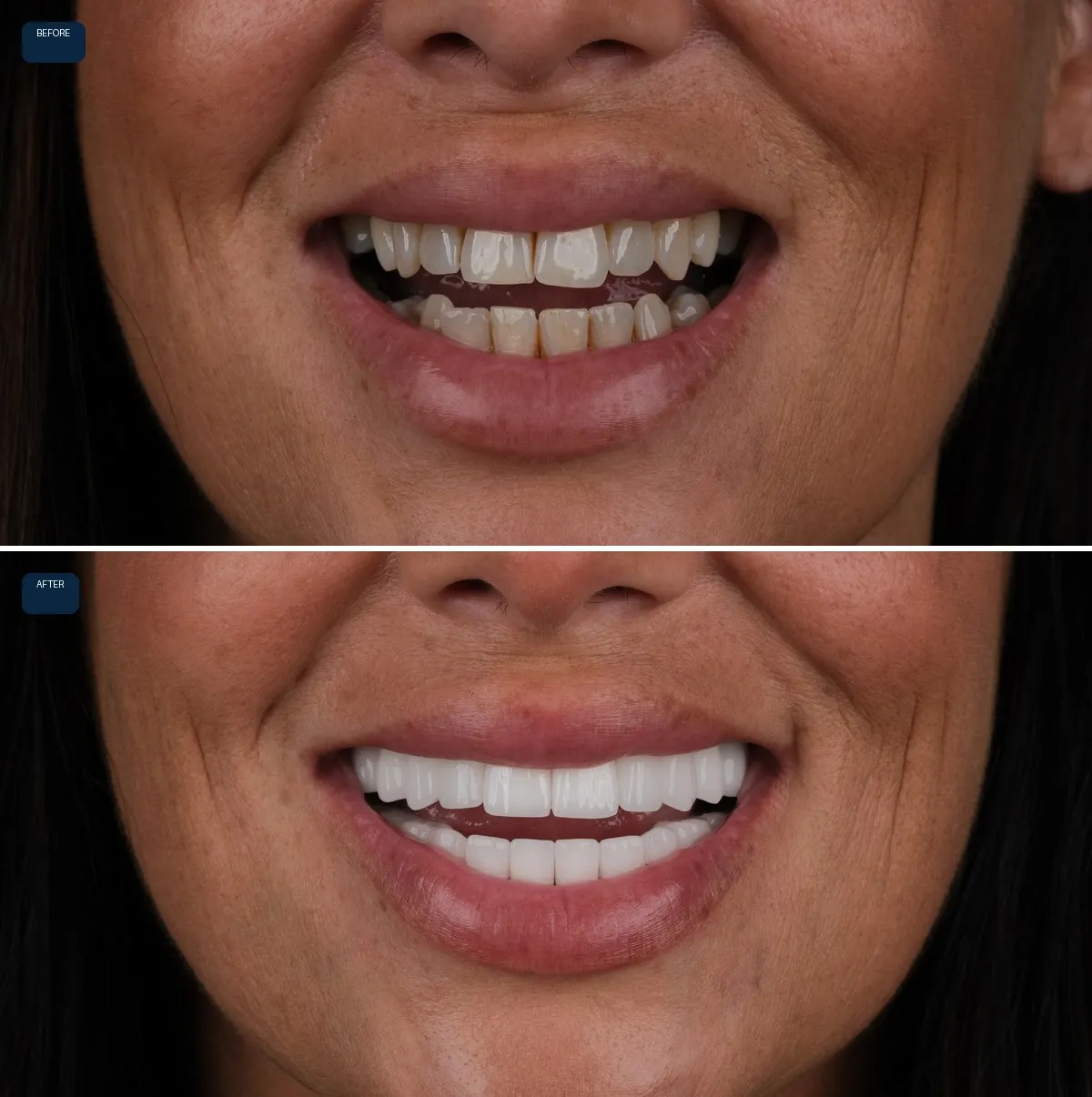 Close-up of Jody's teeth before and after Zirconium Crowns, view 1