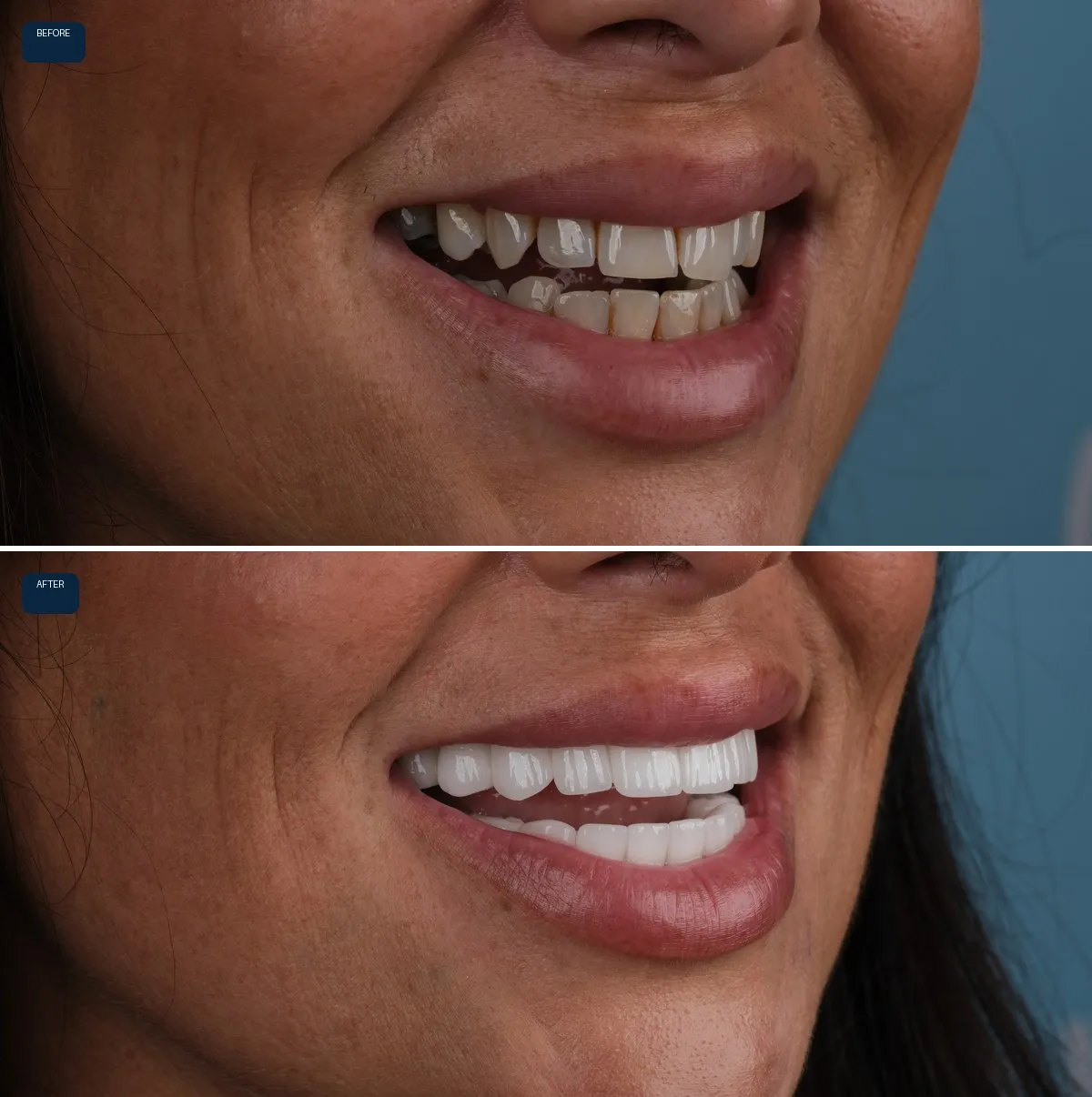 Close-up of Jody's teeth before and after Zirconium Crowns, view 2