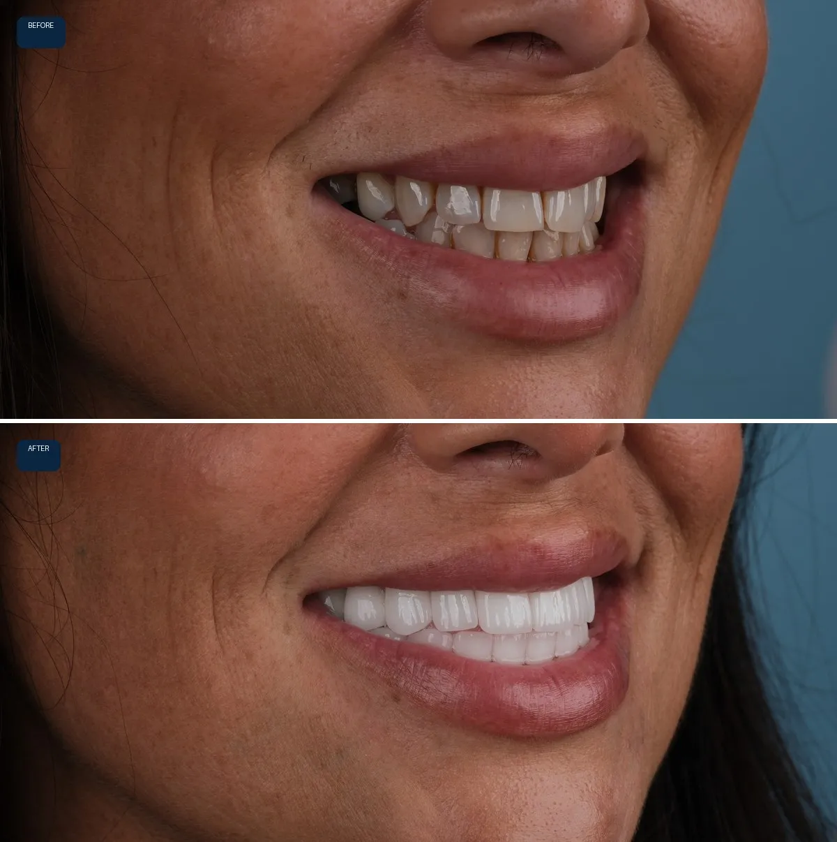 Close-up of Jody's teeth before and after Zirconium Crowns, view 3