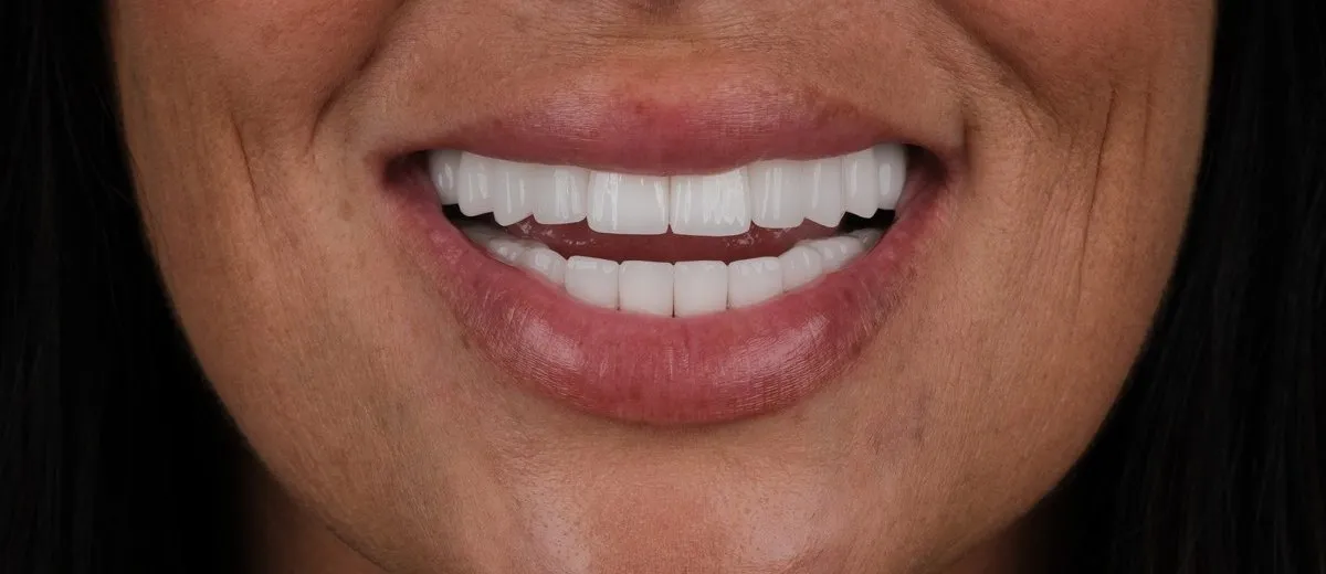 Jody's smile after zirconia crowns in Turkey