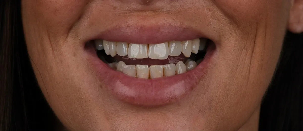 Jody's teeth before crowns