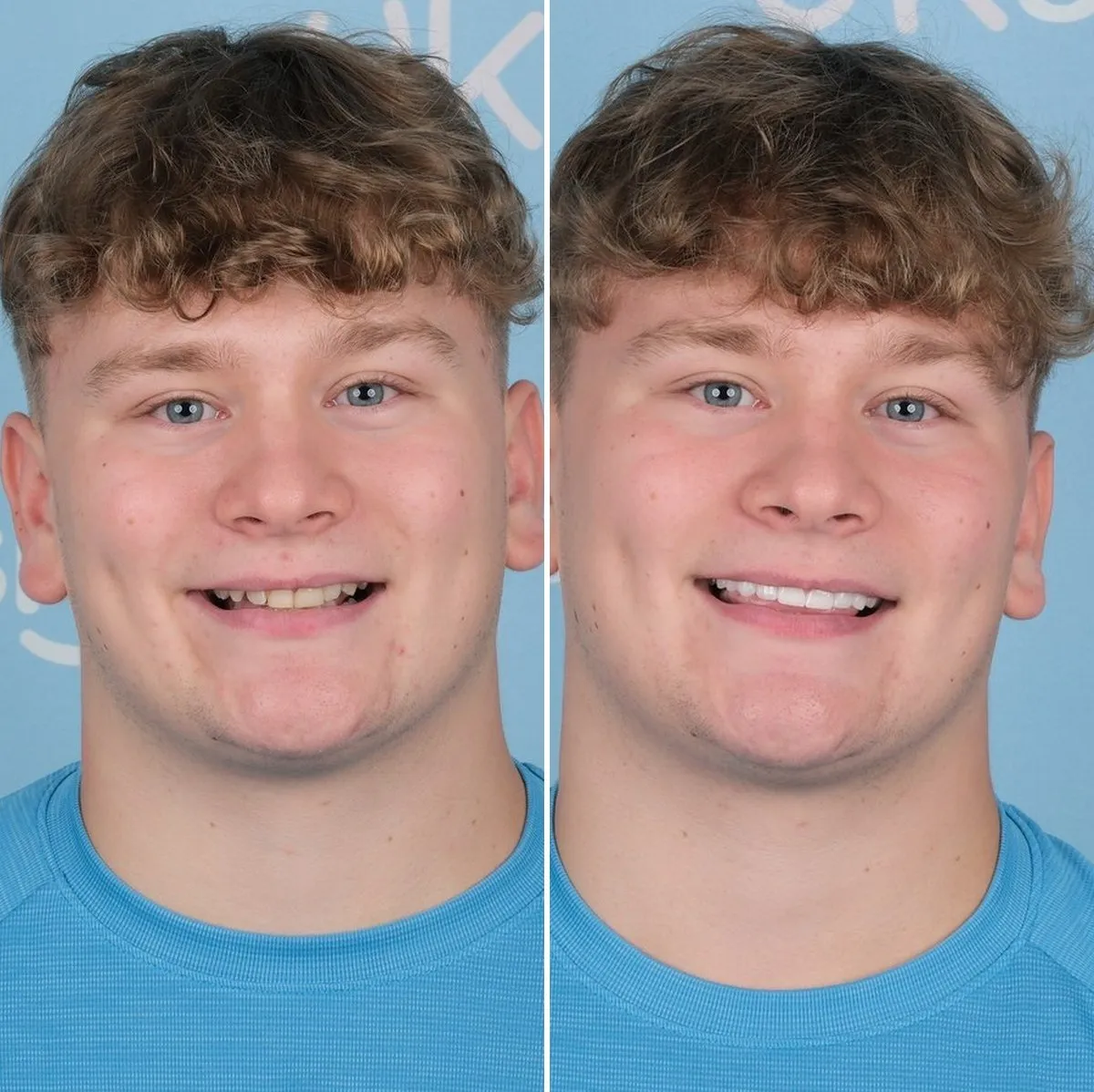 Joe before and after zirconium crowns with UK Smiles