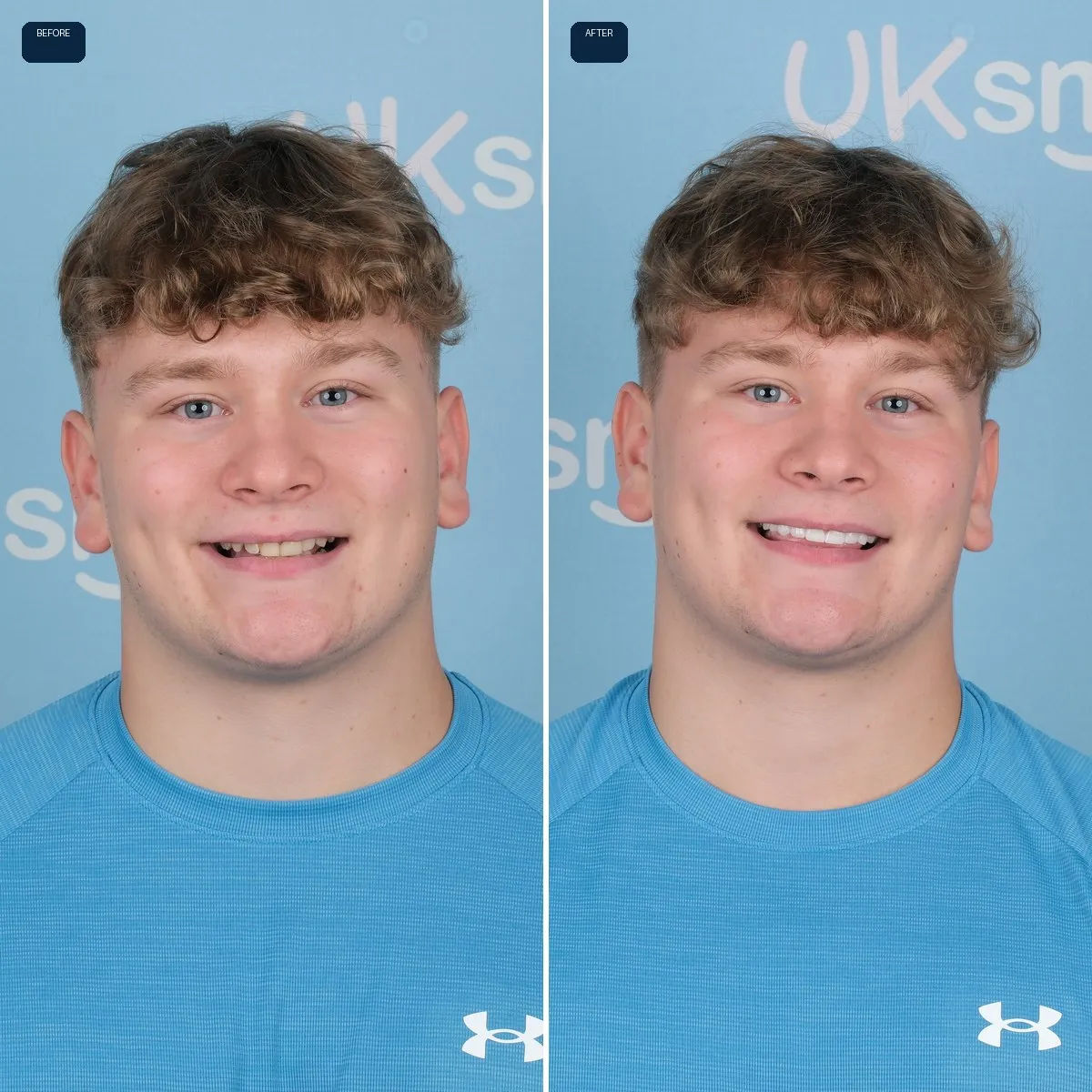Joe's face before and after Zirconium Crowns at UK Smiles in Antalya