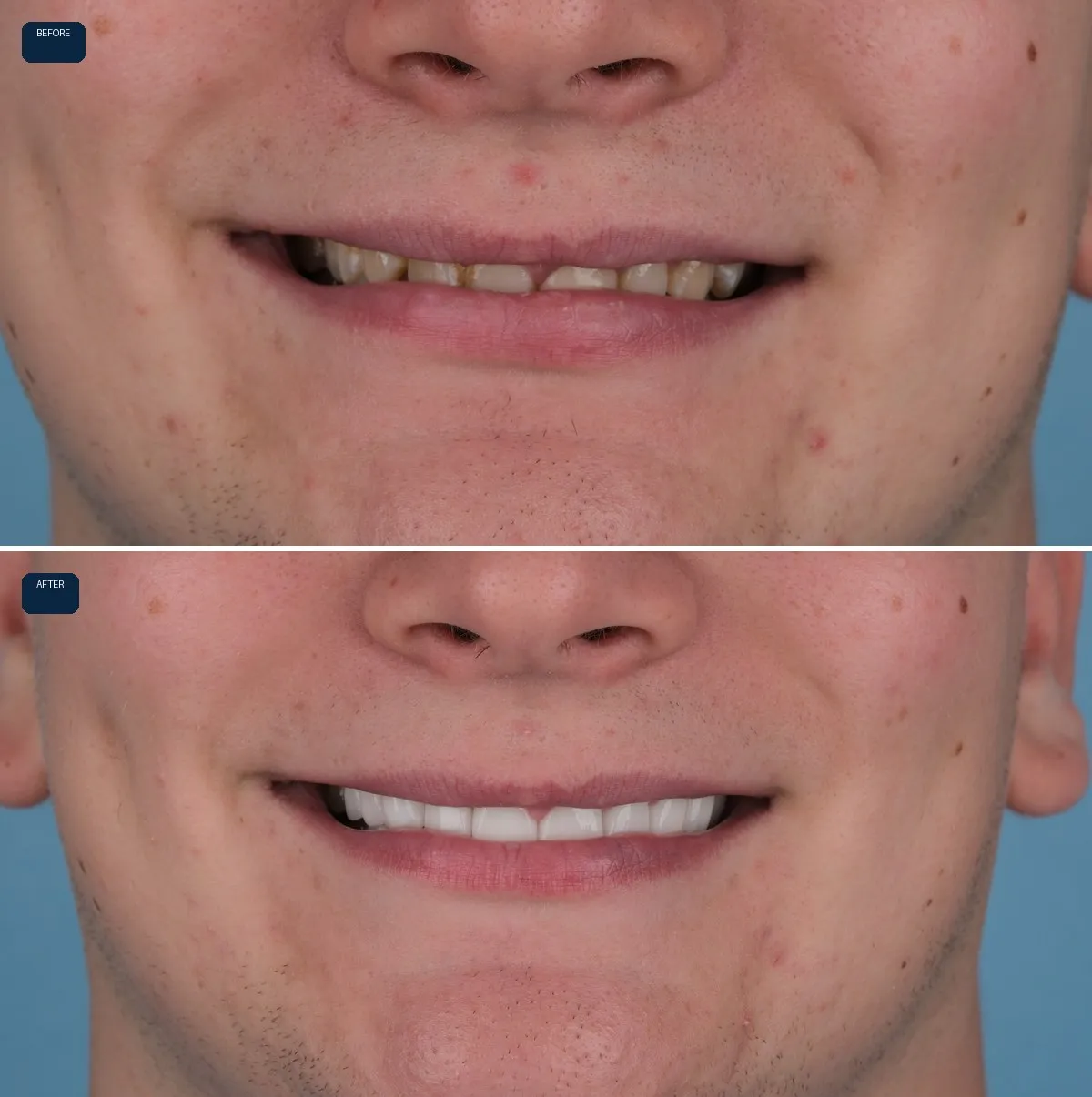 Close-up of Joe's teeth before and after Zirconium Crowns, view 1