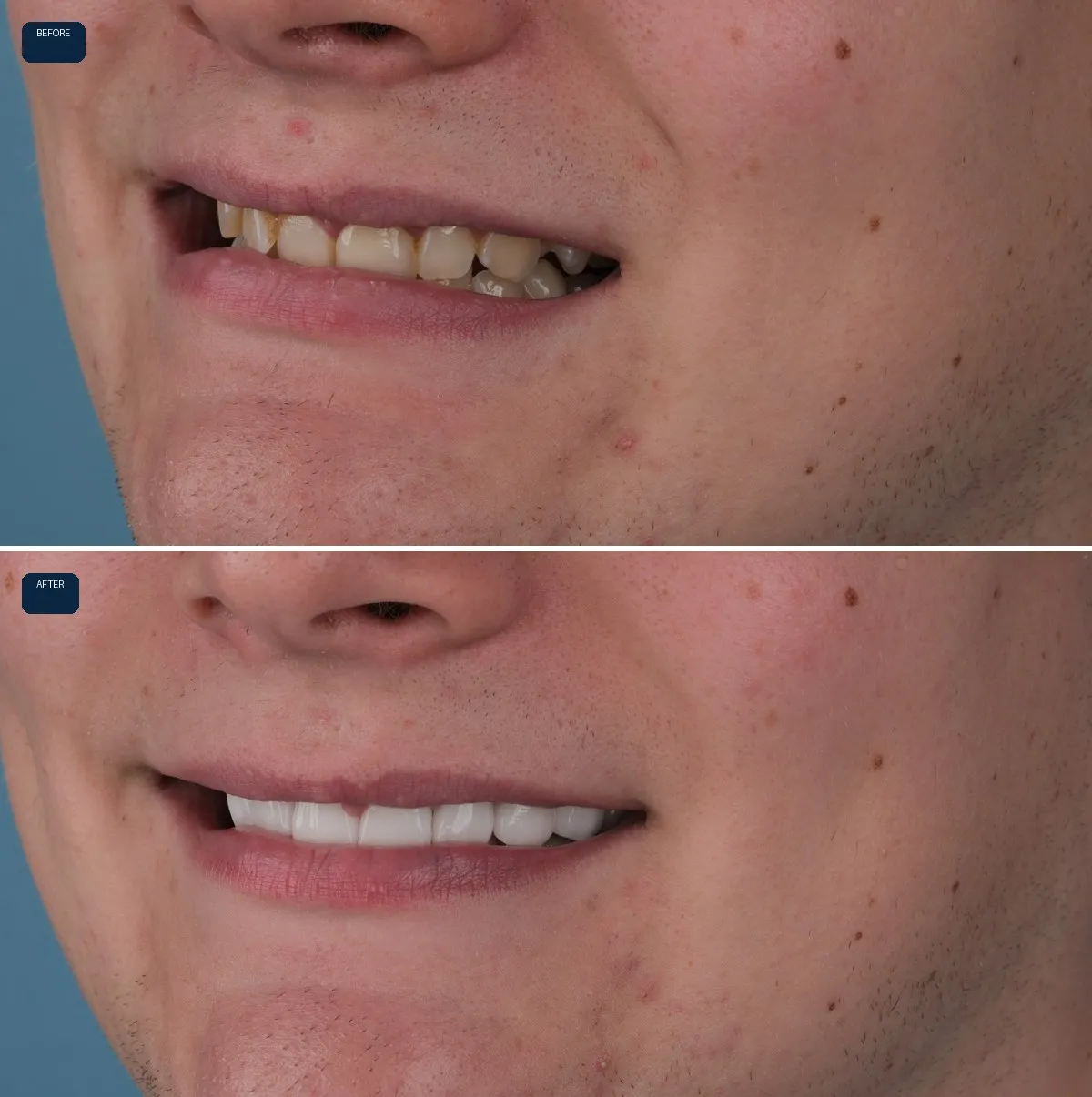 Close-up of Joe's teeth before and after Zirconium Crowns, view 2
