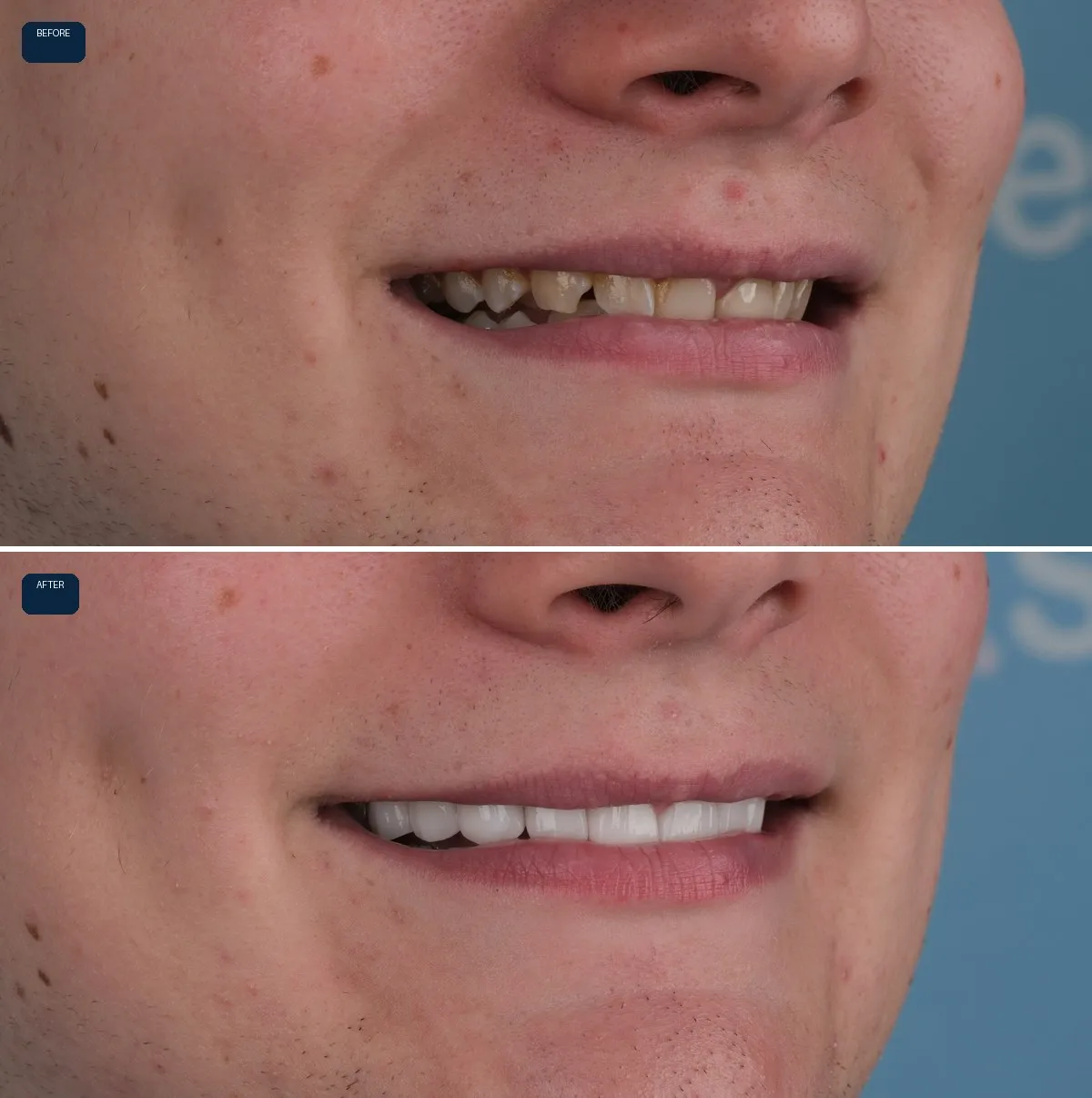 Close-up of Joe's teeth before and after Zirconium Crowns, view 3
