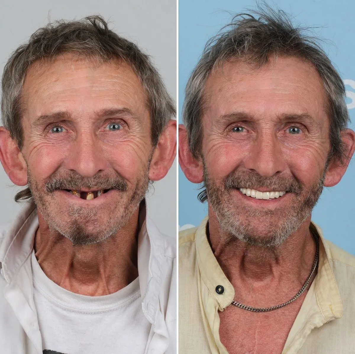 John before and after zirconia crowns with UK Smiles