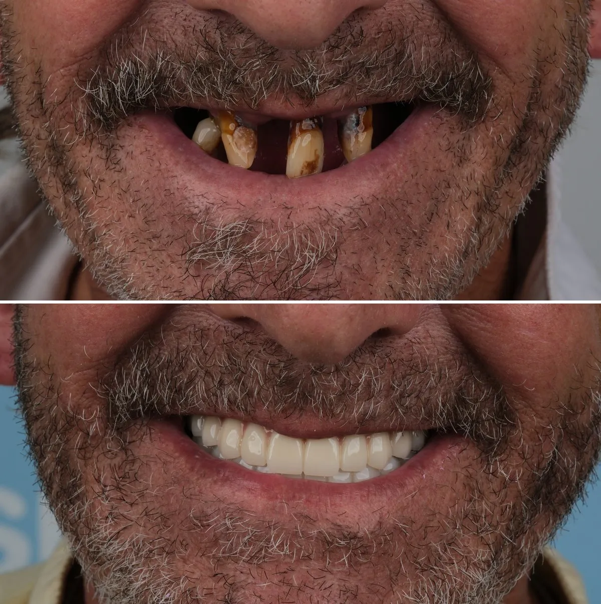 Close-up of John's teeth before and after Zirconia Crowns, view 1