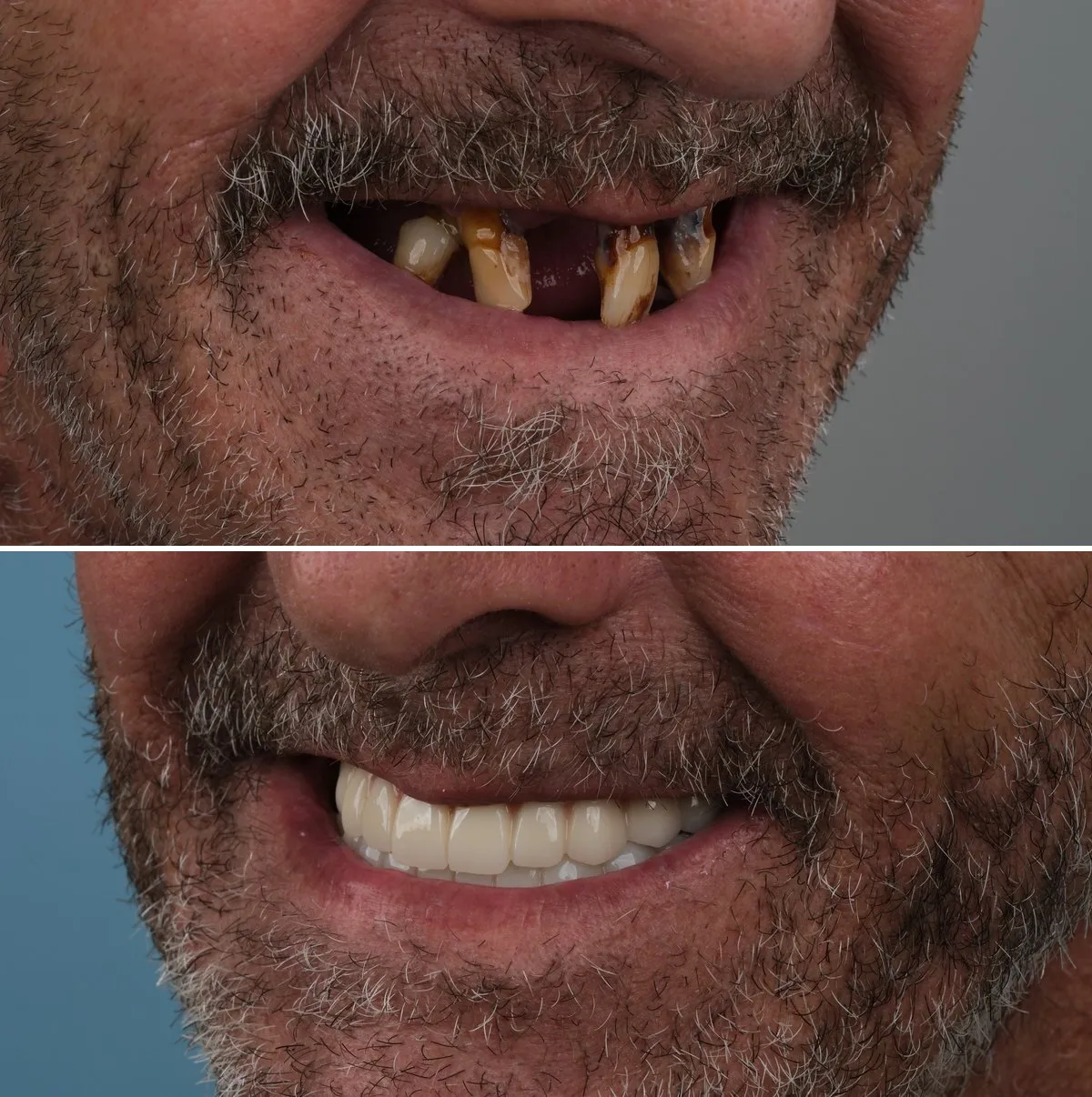 Close-up of John's teeth before and after Zirconia Crowns, view 2