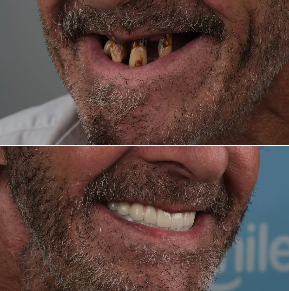 Close-up of John's teeth before and after Zirconia Crowns, view 3