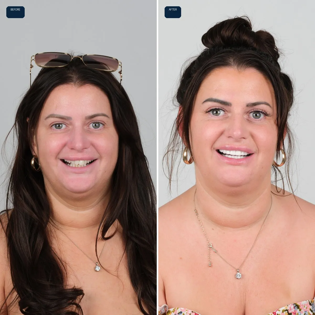 Katie's face before and after Zirconia Crowns at UK Smiles in Antalya