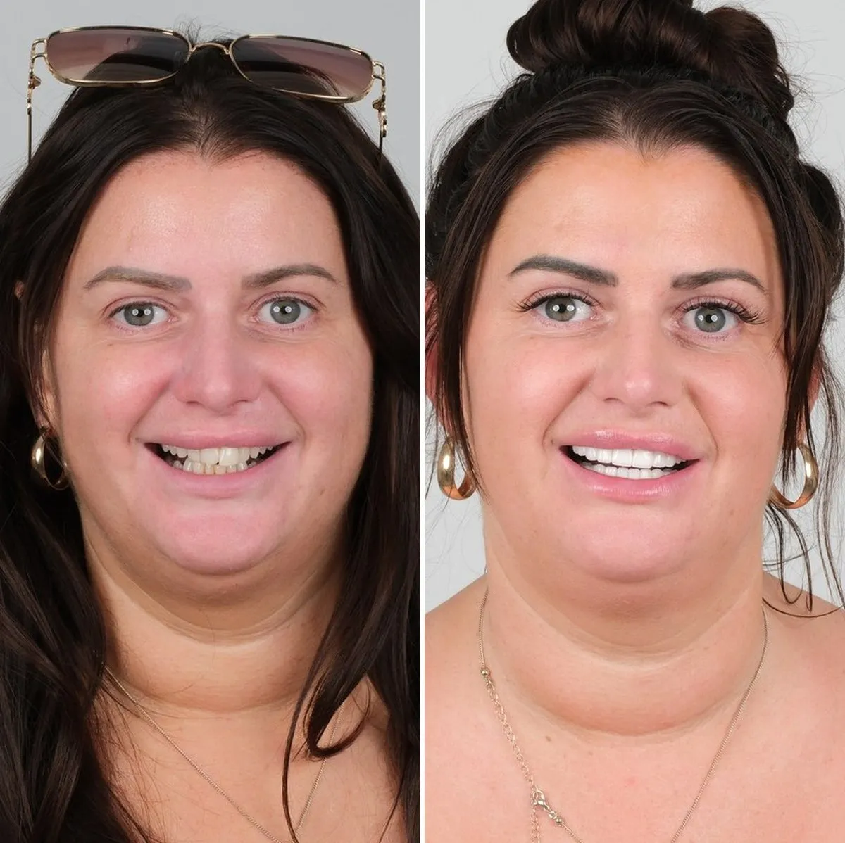 Katie before and after zirconia crowns with UK Smiles