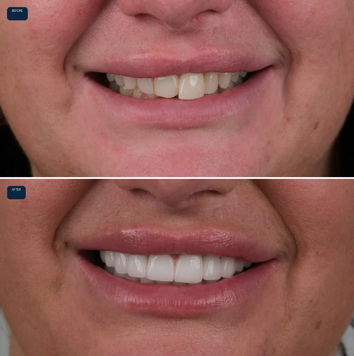 Close-up of Katie's teeth before and after Zirconia Crowns, view 1