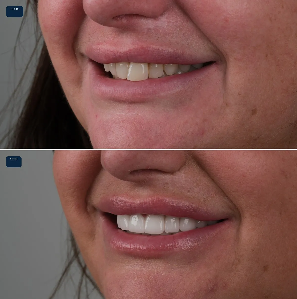 Close-up of Katie's teeth before and after Zirconia Crowns, view 2