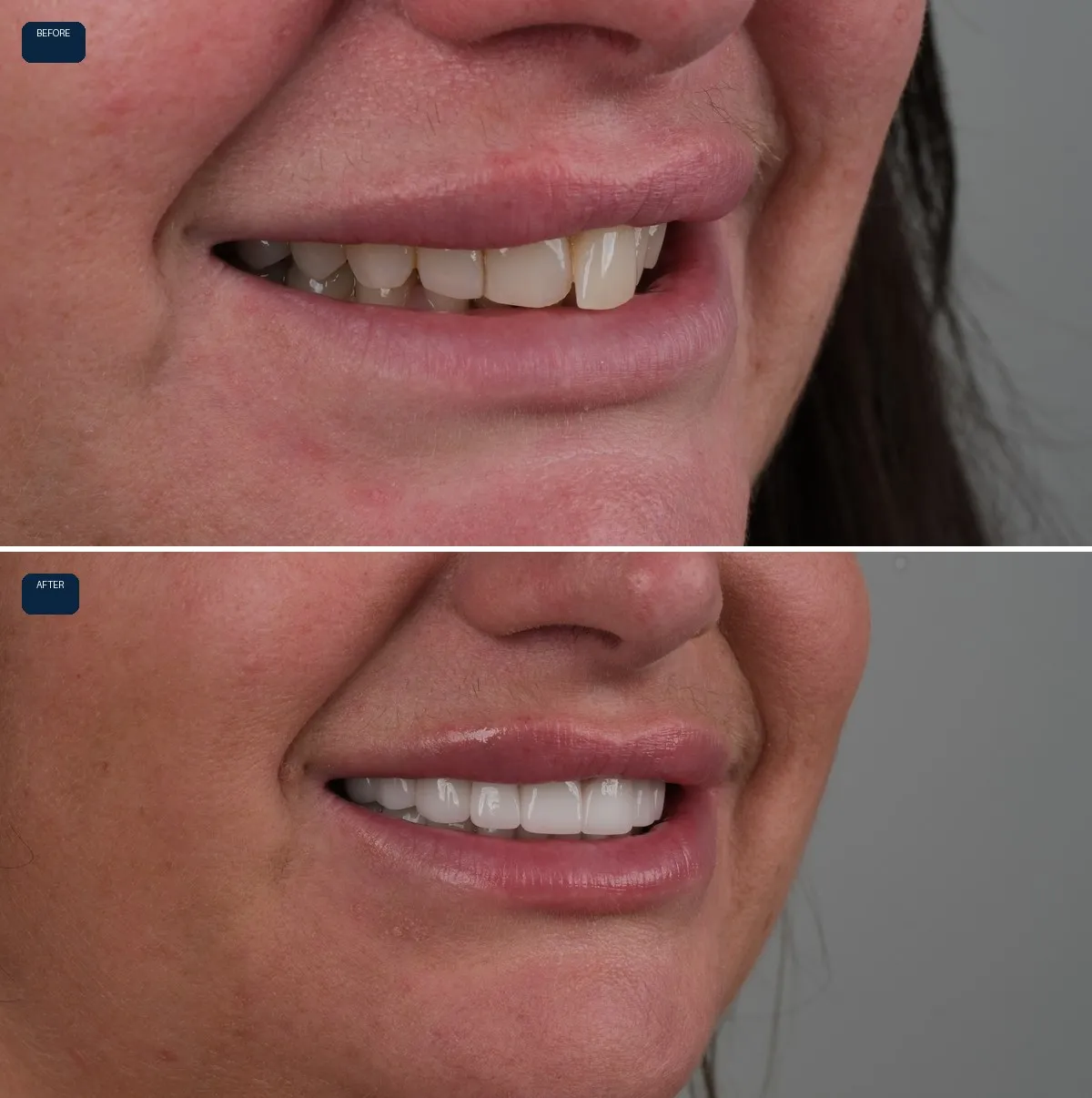 Close-up of Katie's teeth before and after Zirconia Crowns, view 3