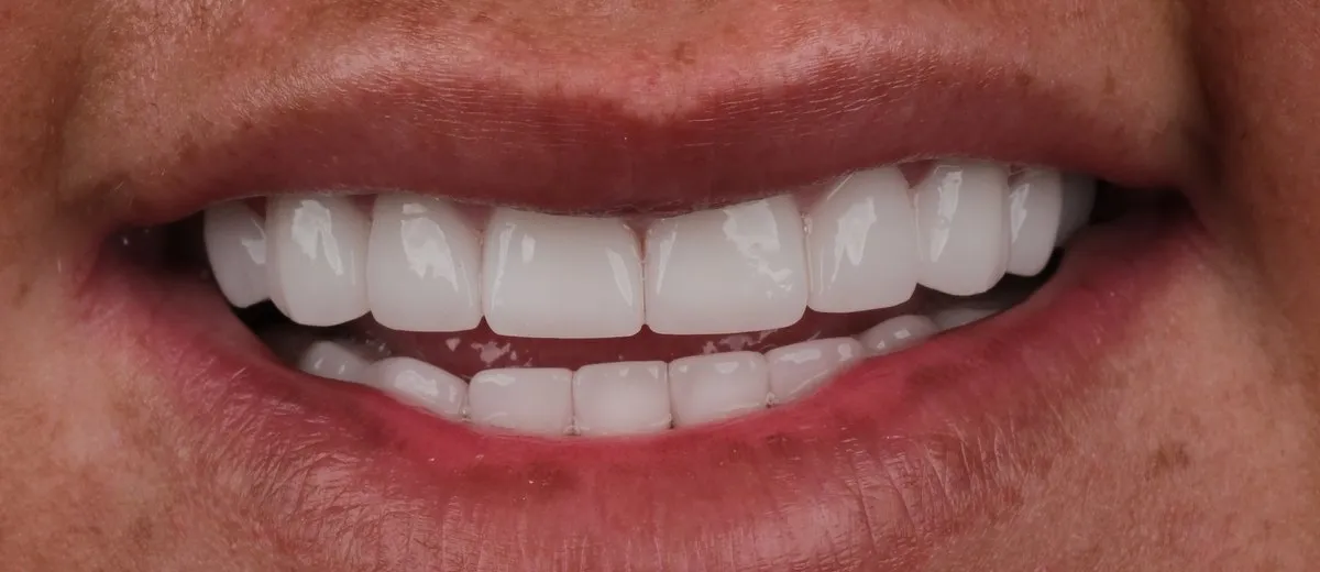 A UK Smiles patient's smile after treatment: BL1 shade, Hollywood style