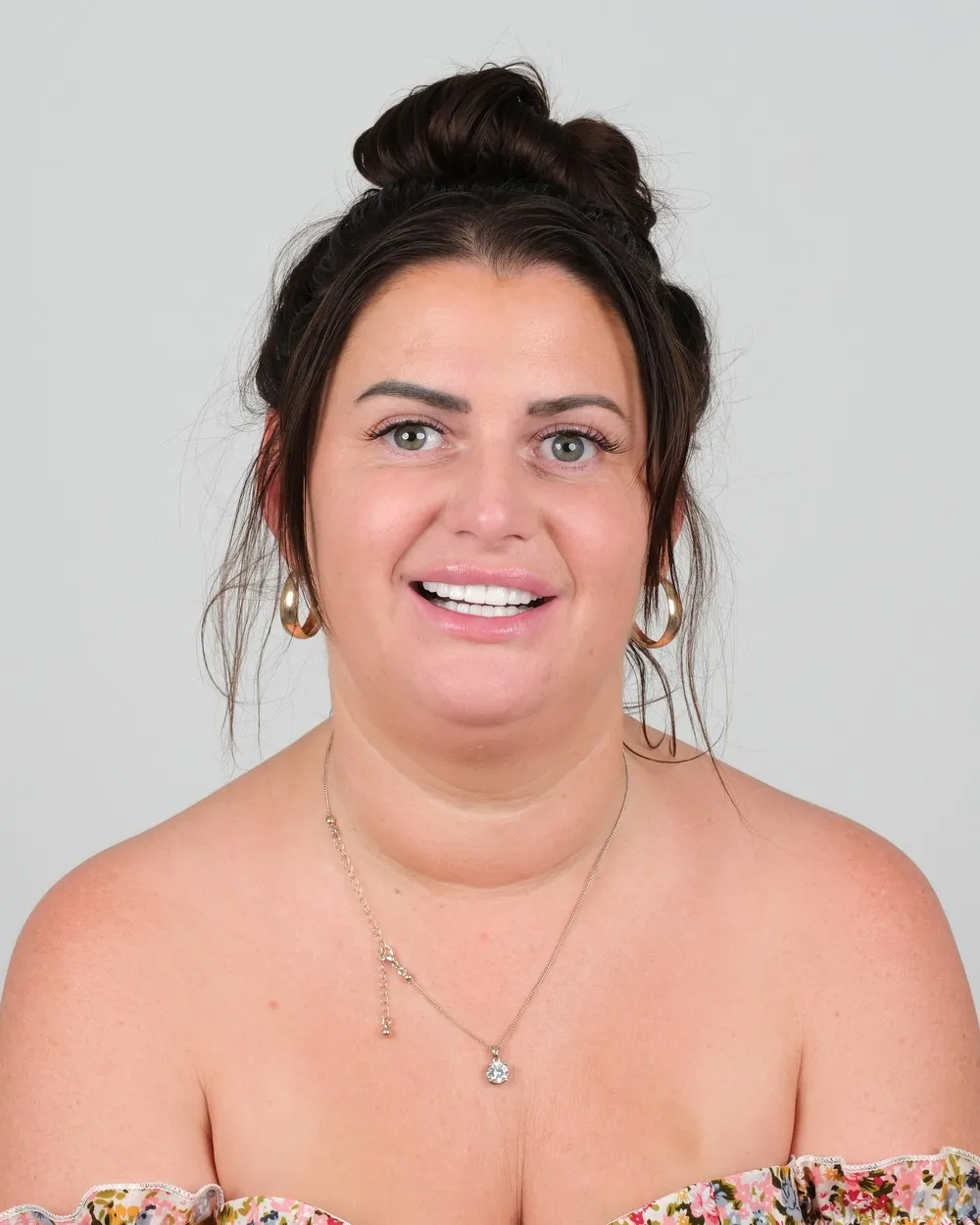 Katie after Zirconia Crowns with UK Smiles in Antalya