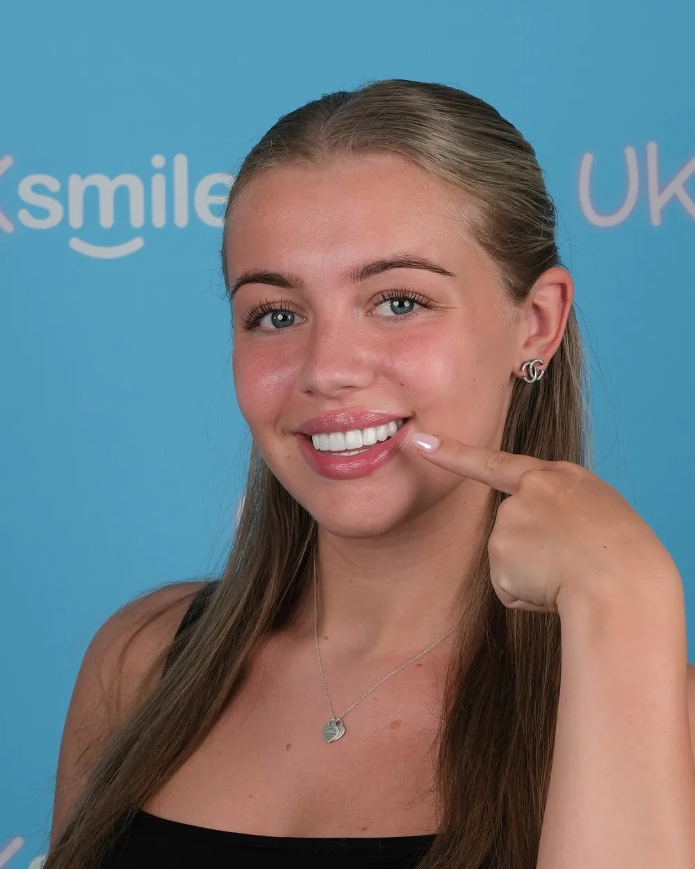 Kelsey after Emax Laminate Veneers with UK Smiles in Antalya