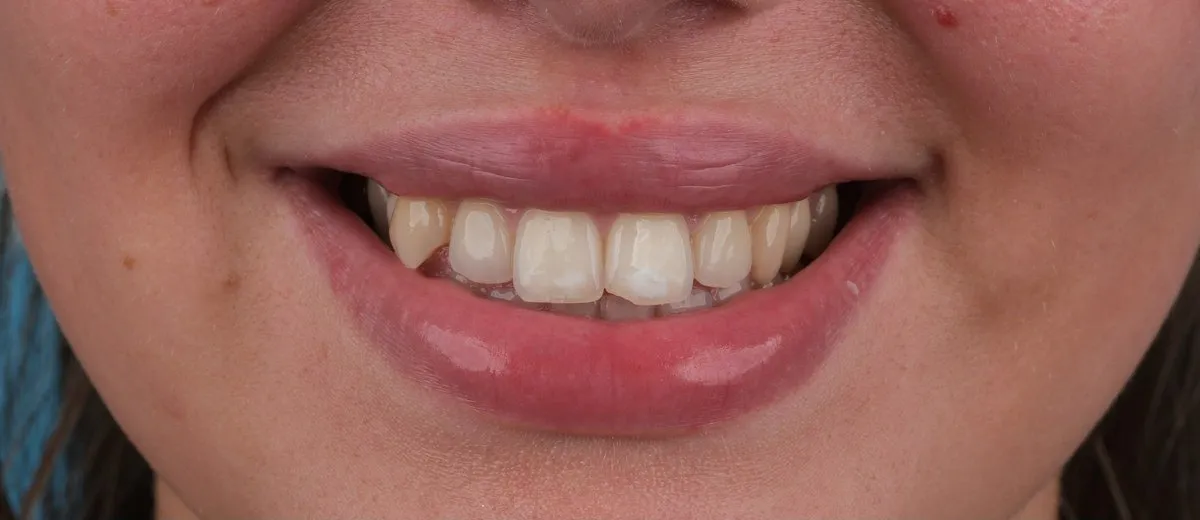 Kelsey before Emax laminate veneers with UK Smiles